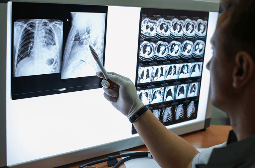 Does Medicare Cover Lung Cancer Screening? | ClearMatch Medicare