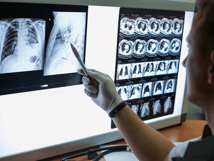 Does Medicare Cover Lung Cancer Screening