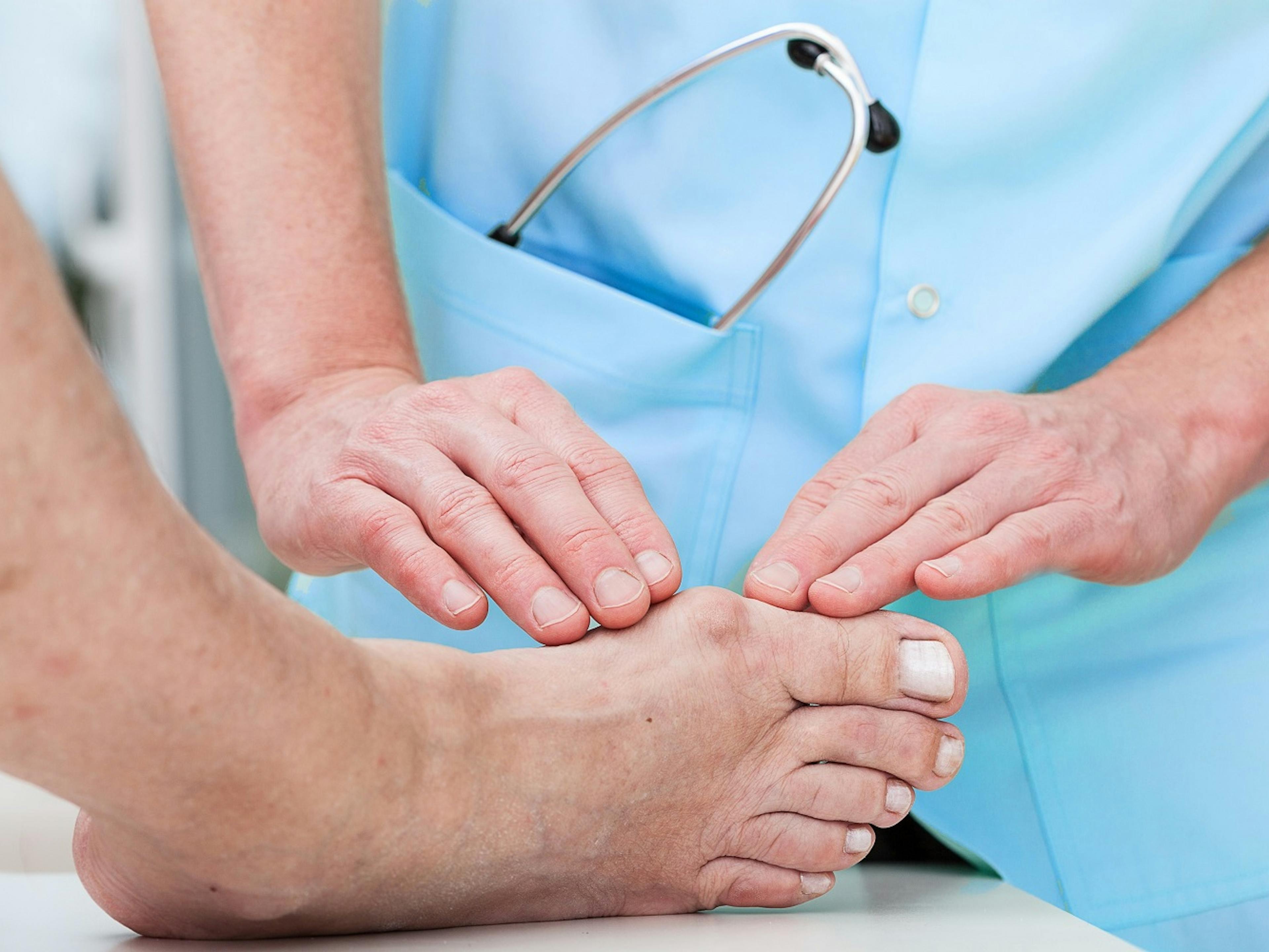 Does Medicare Cover Bunion Surgery?