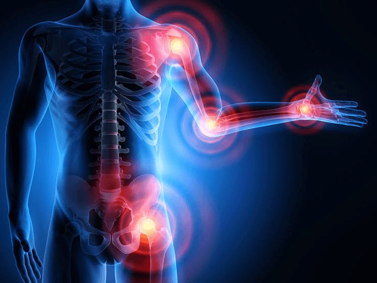 digital image of arthritis