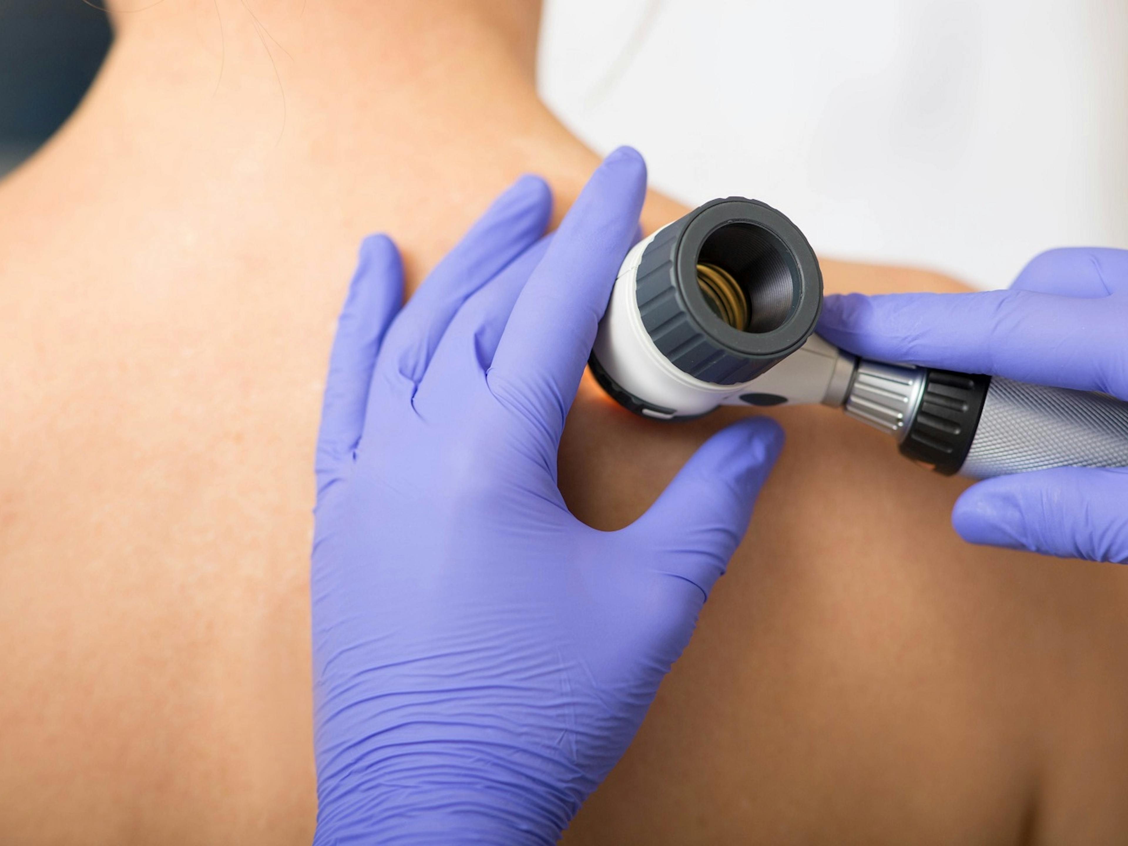 Does Medicaid Cover a Dermatologist?