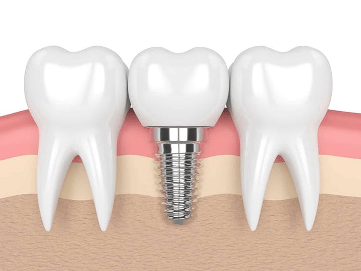 Does Medicare Cover Dental Implants?