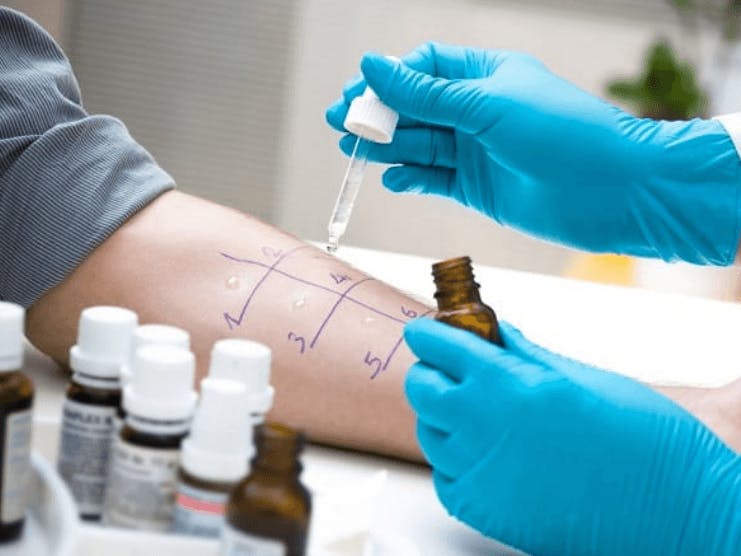 Does Medicare Cover Allergy Testing