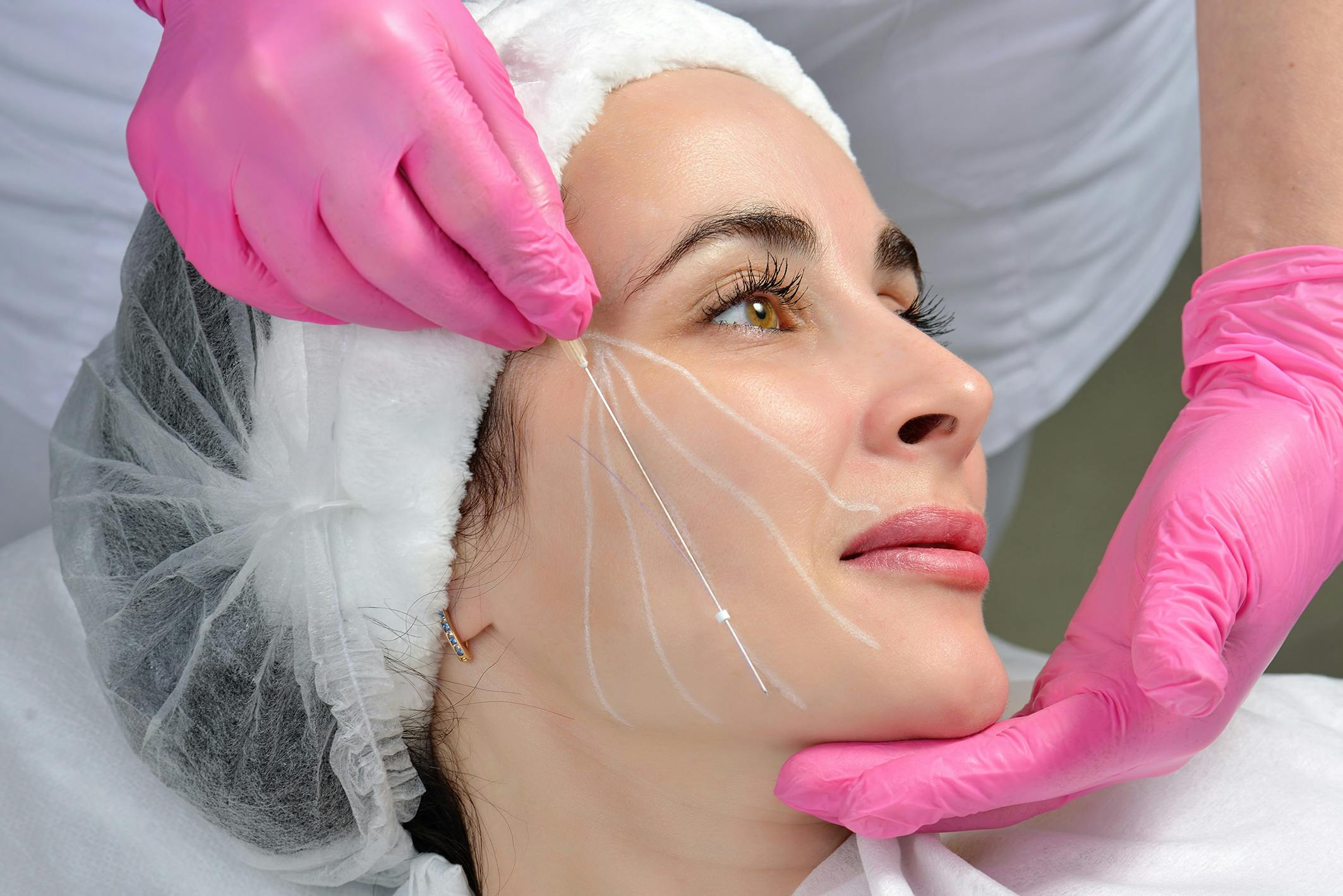 A woman having COG Thread Lift treatment