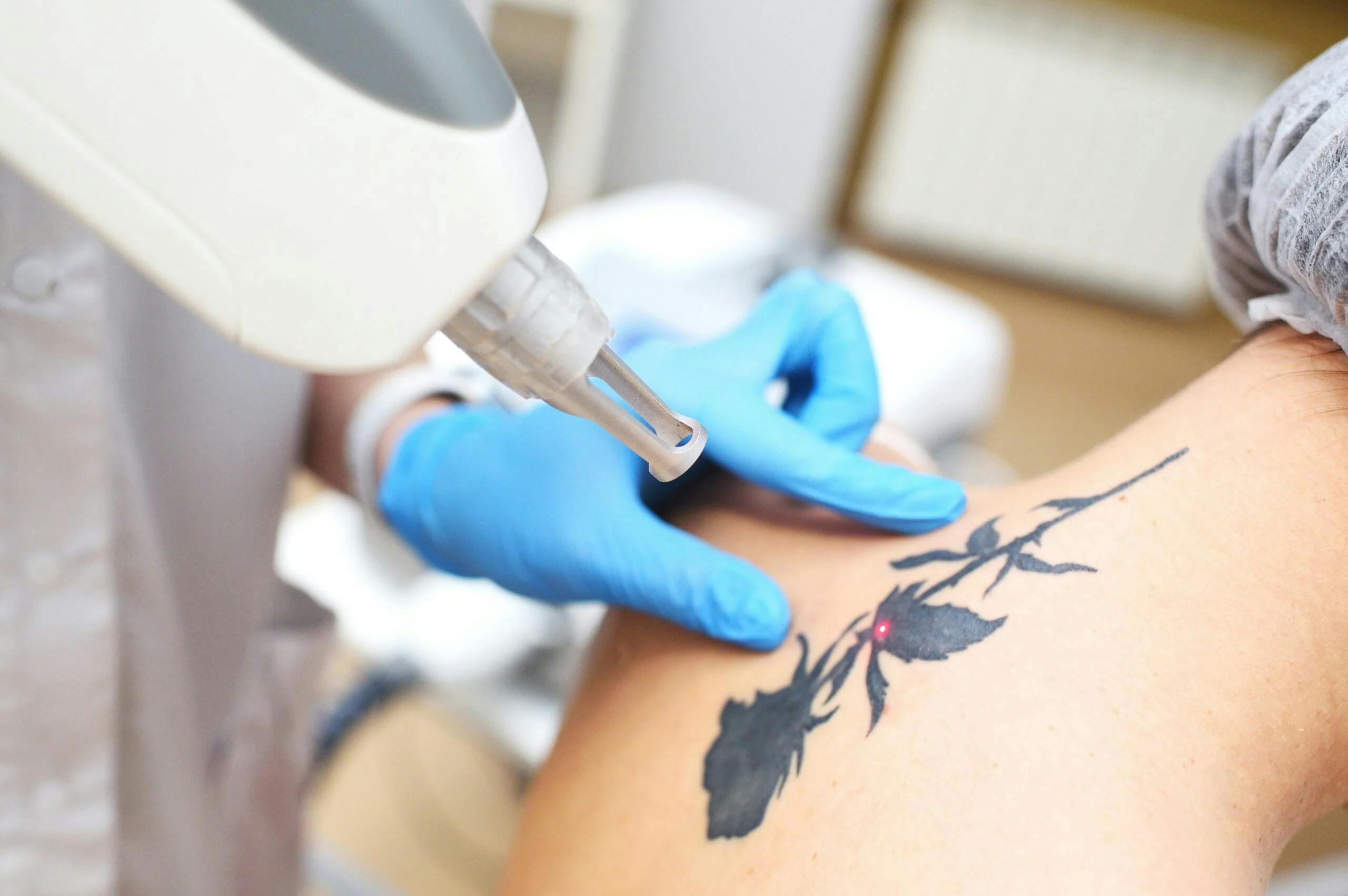 A patient having Laser Tattoo Removal