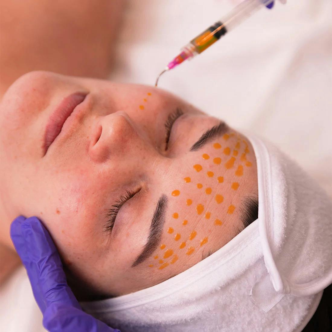 A female patient receiving BioRePeel treatment
