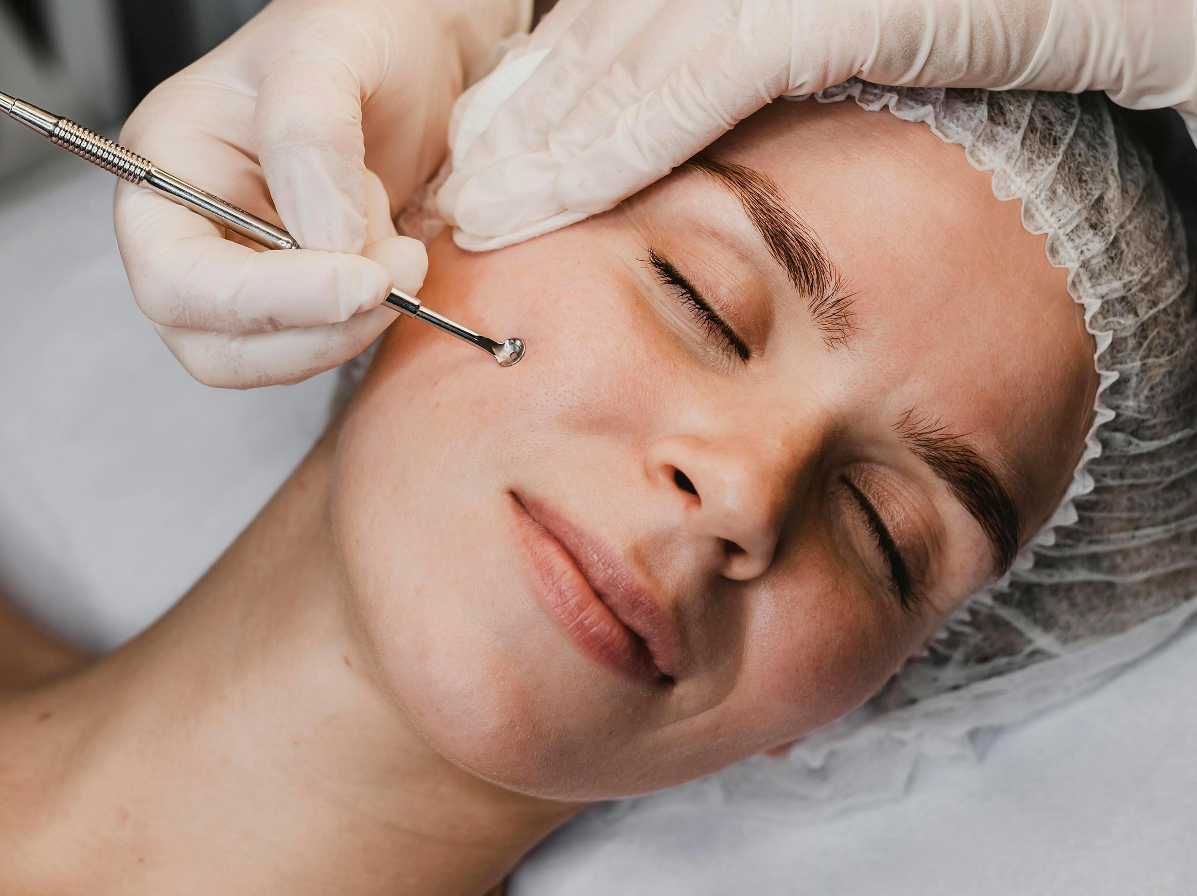 A female patient receiving Dermaplaning treatment