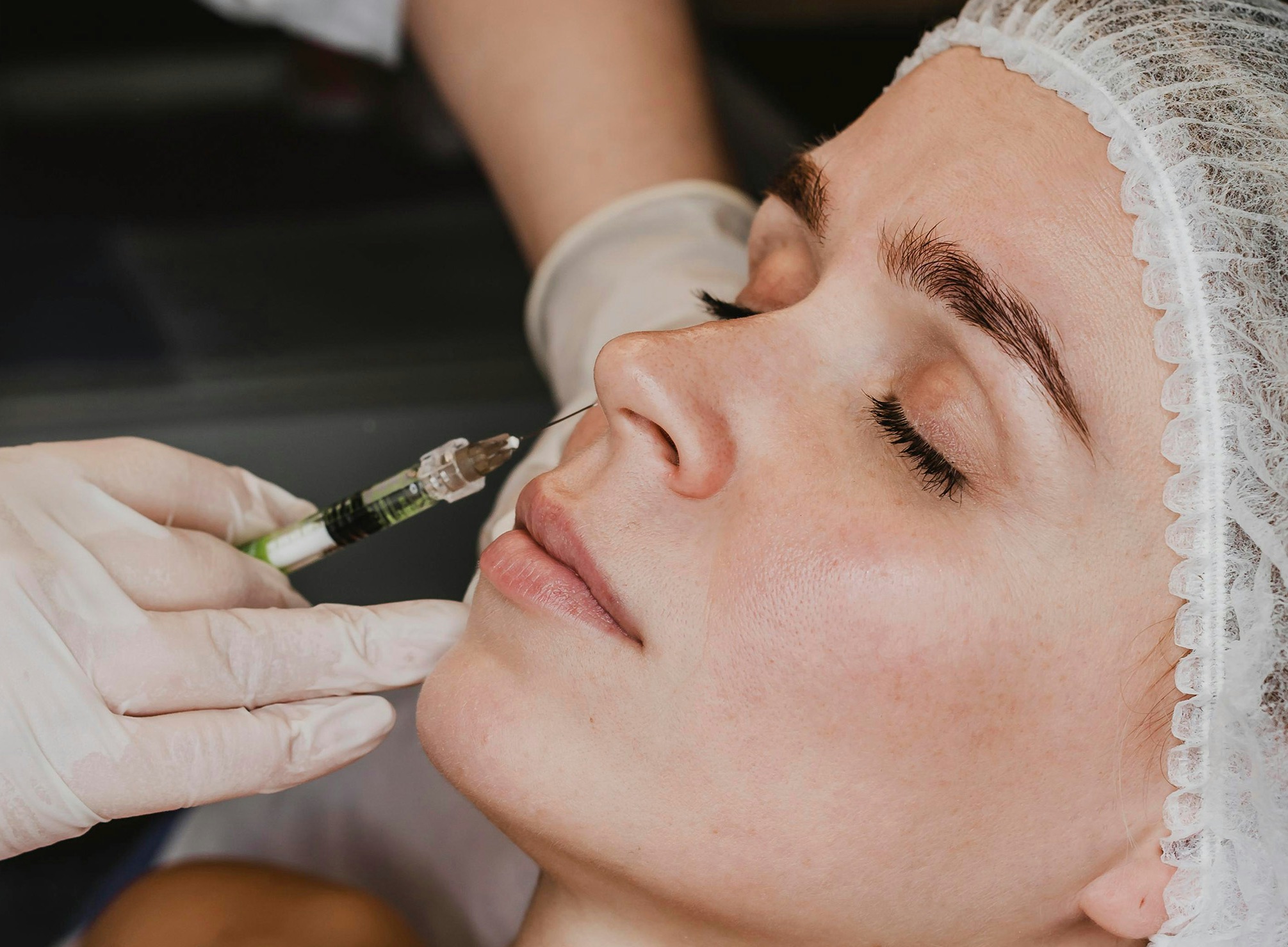 A woman having Profhilo treatment