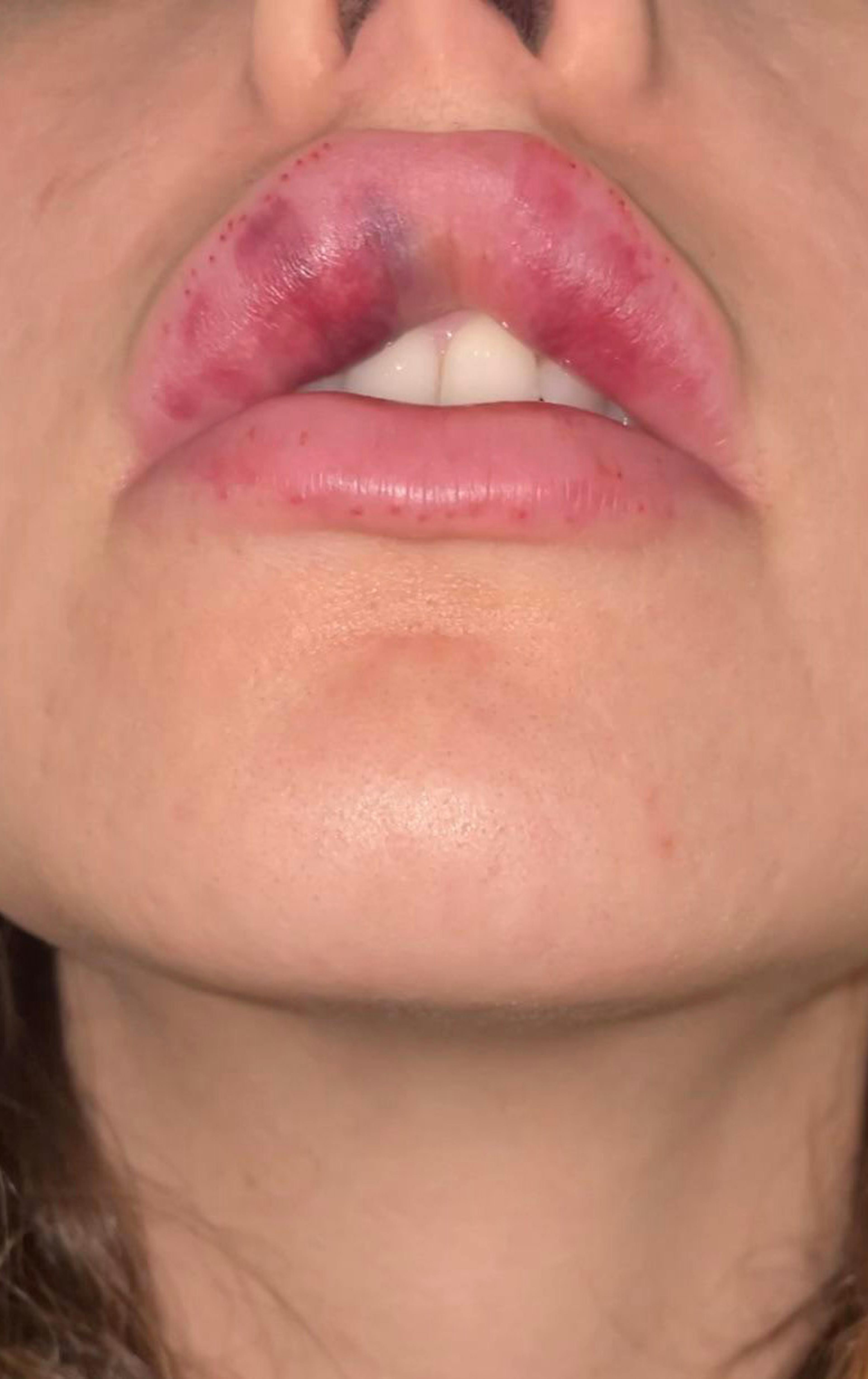 A womans lip filler complication
