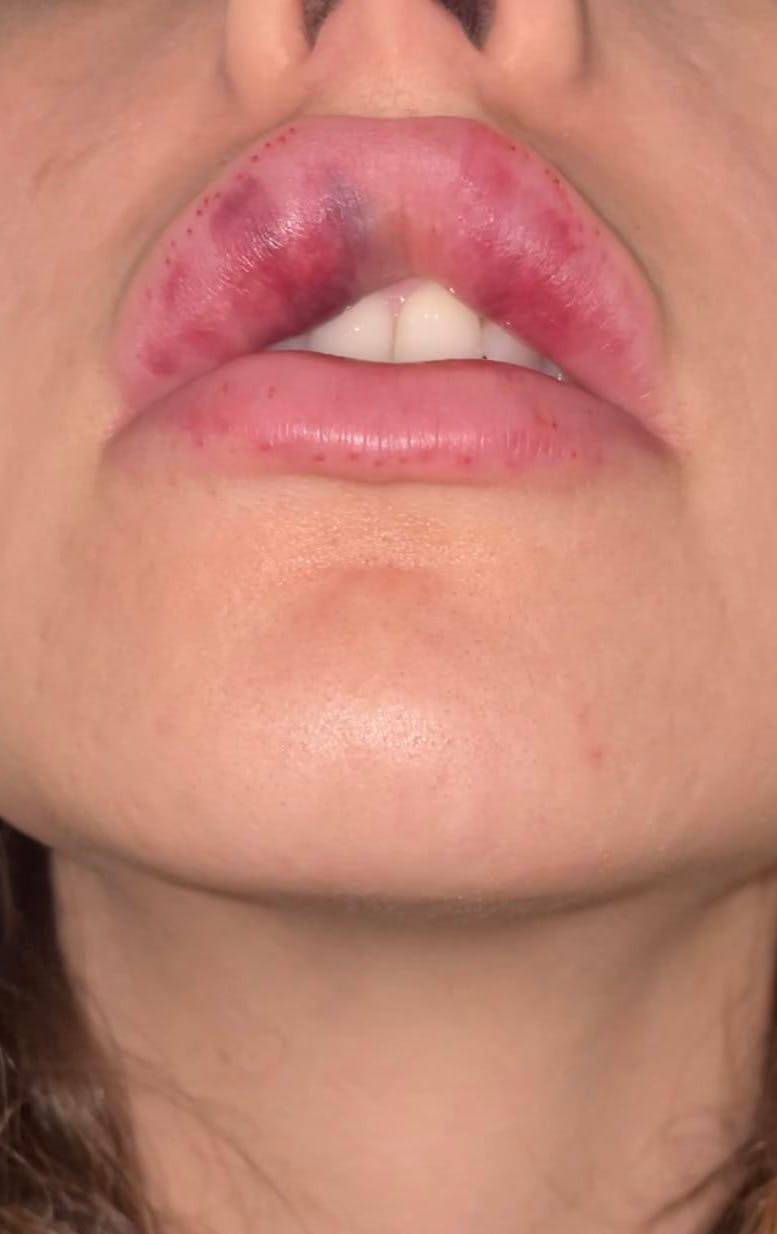 A womans lip filler complication