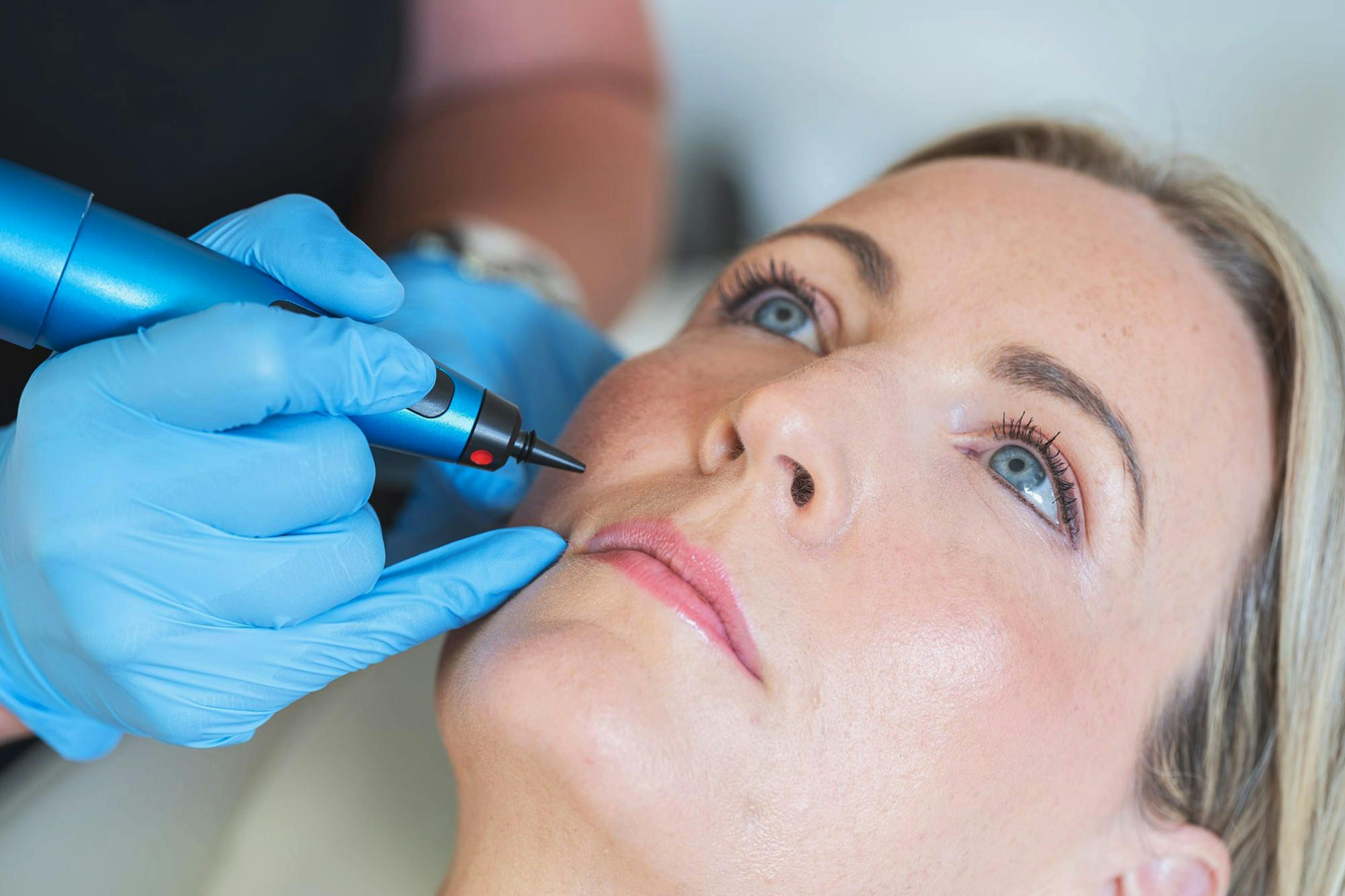 A female patient receiving Cryotherapy treatment