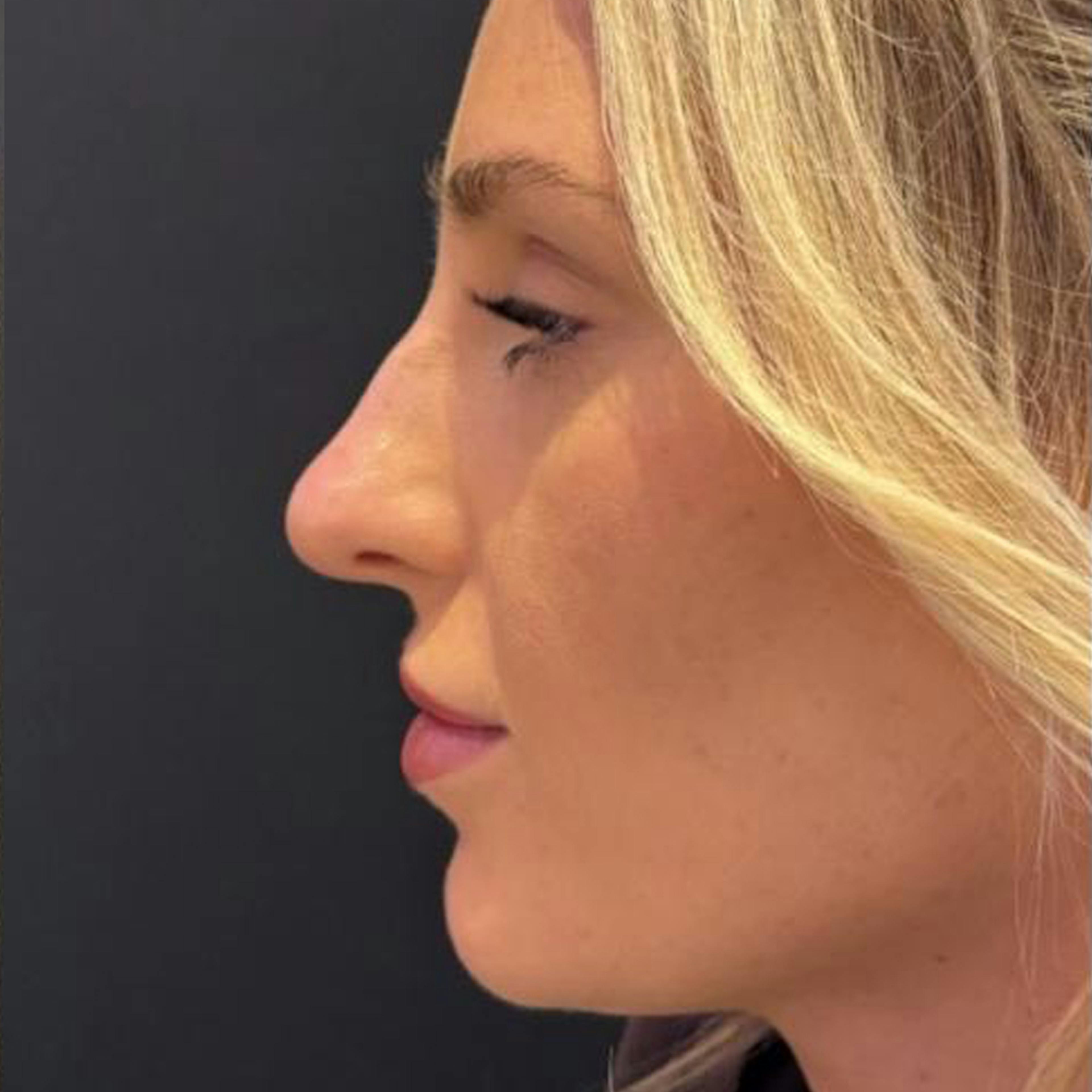 Non surgical rhinoplasty (before)