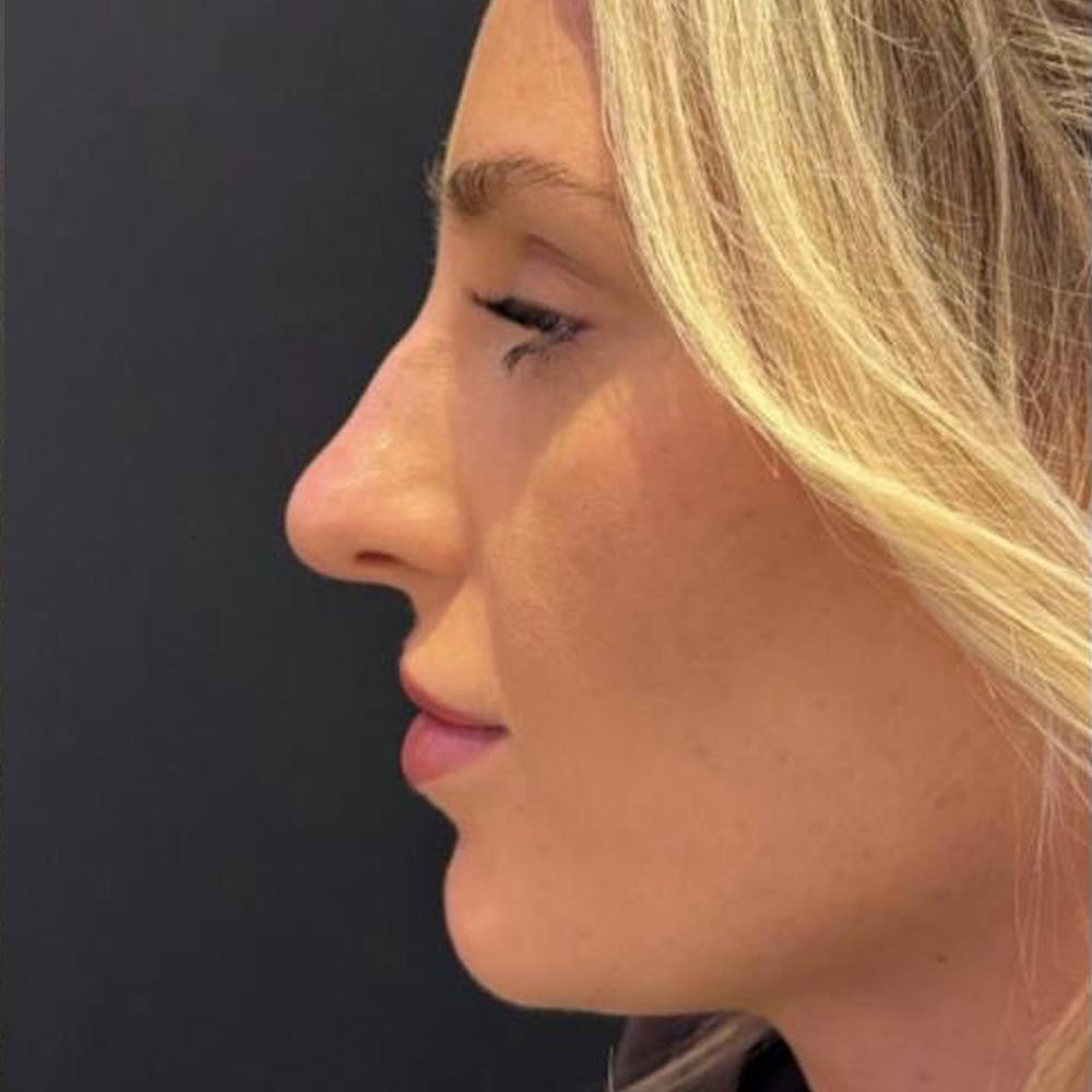 Non surgical rhinoplasty (before)