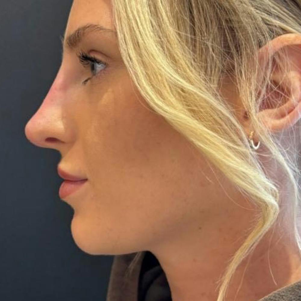 Non surgical rhinoplasty (after)