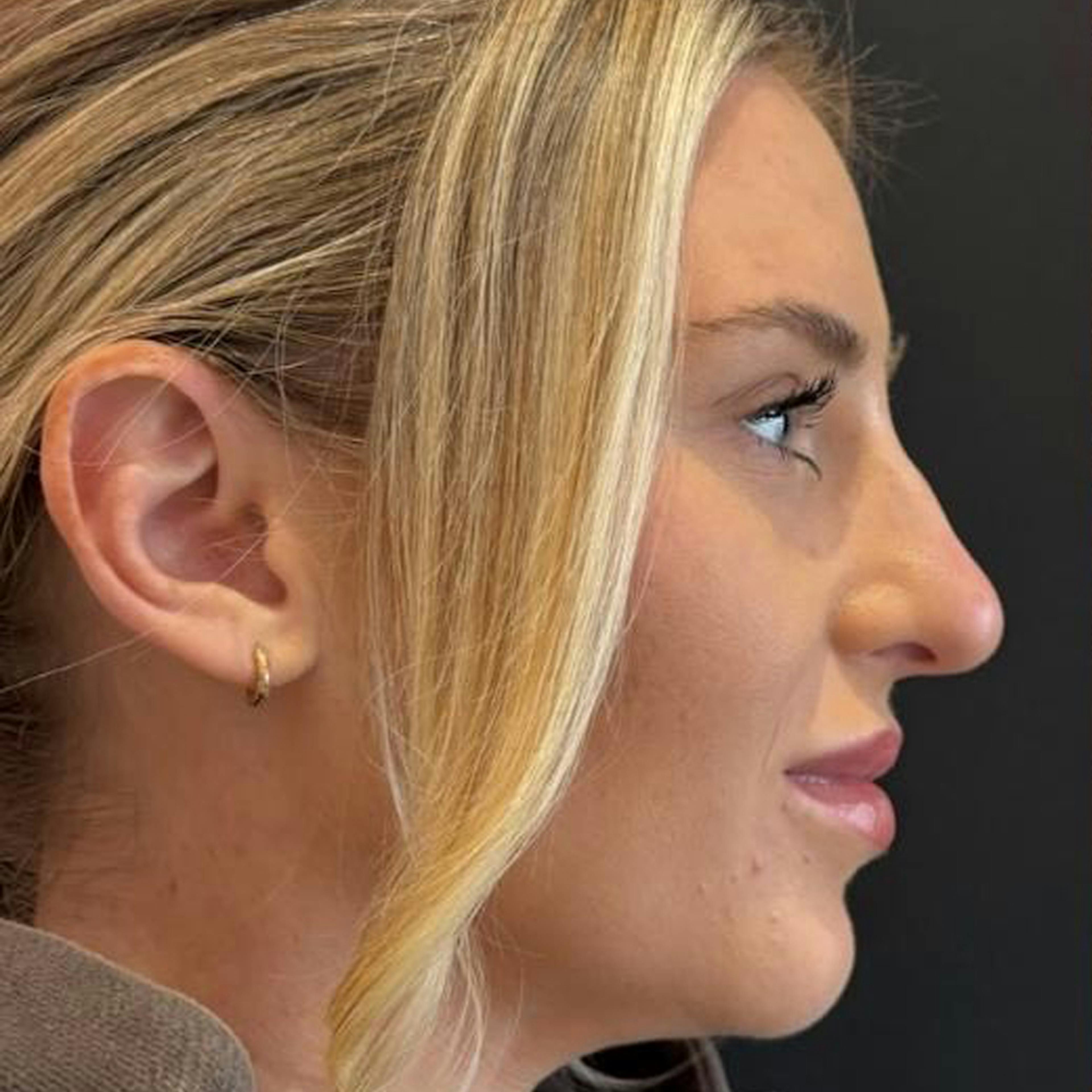 Non surgical rhinoplasty (before)