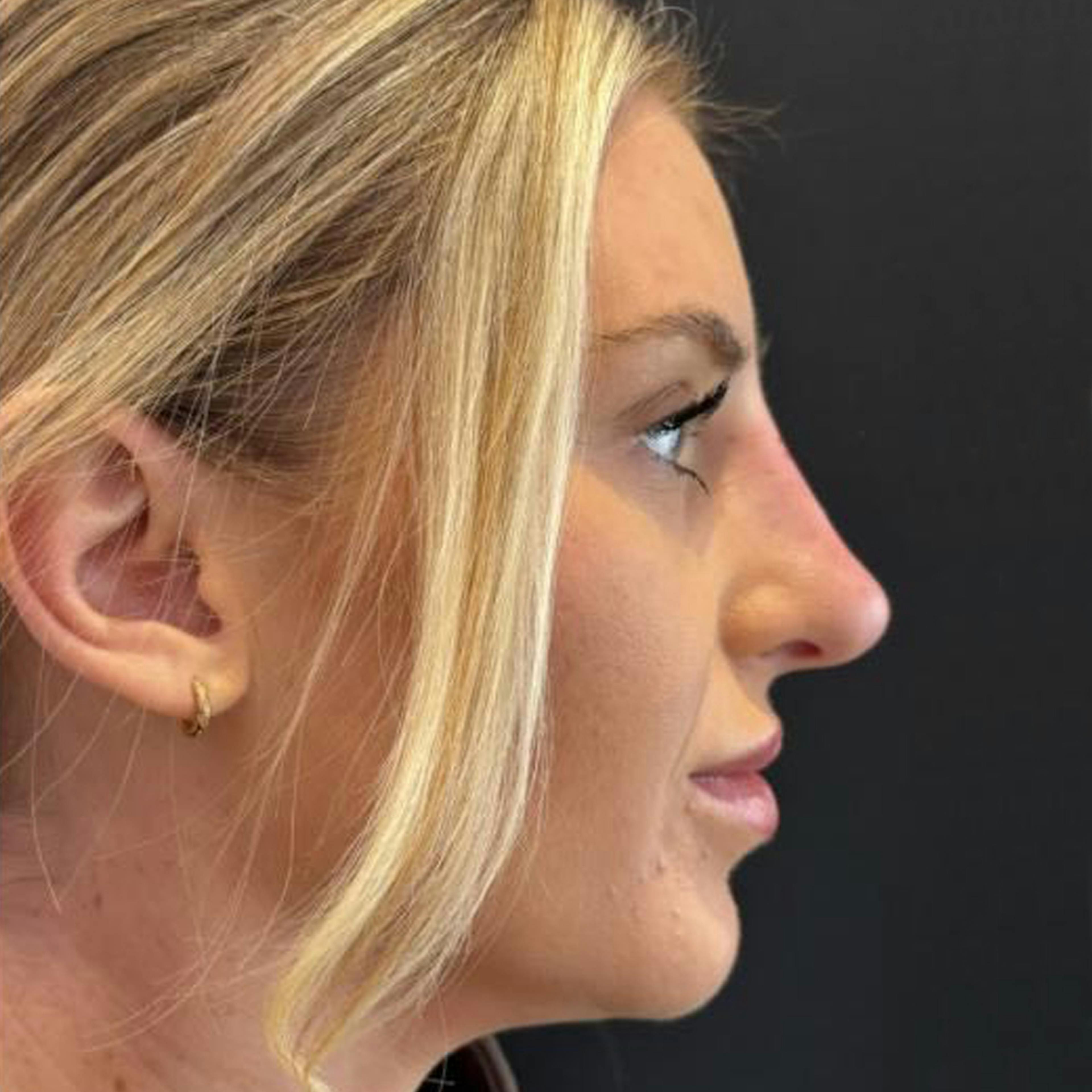 Non surgical rhinoplasty (after)