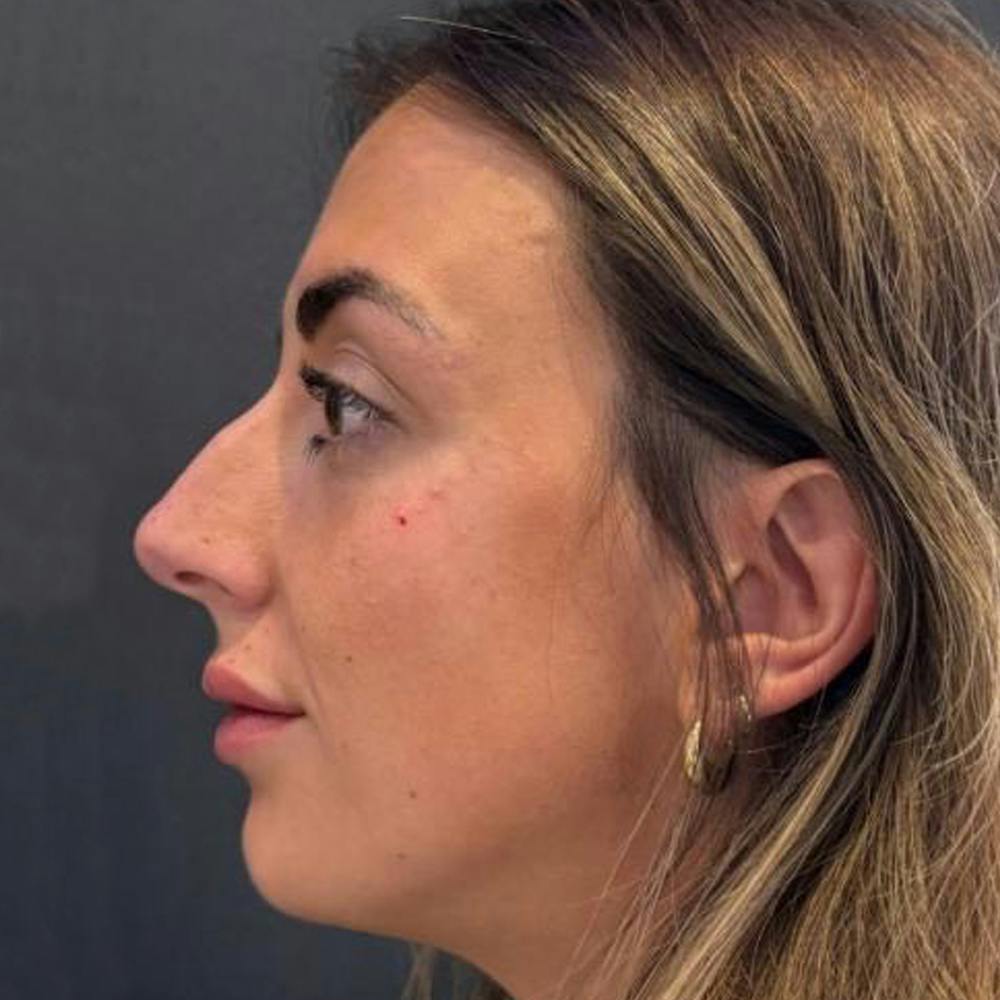 Non surgical rhinoplasty (before)
