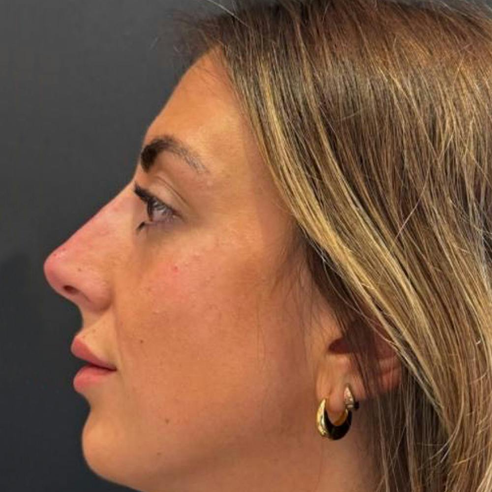 Non surgical rhinoplasty (after)