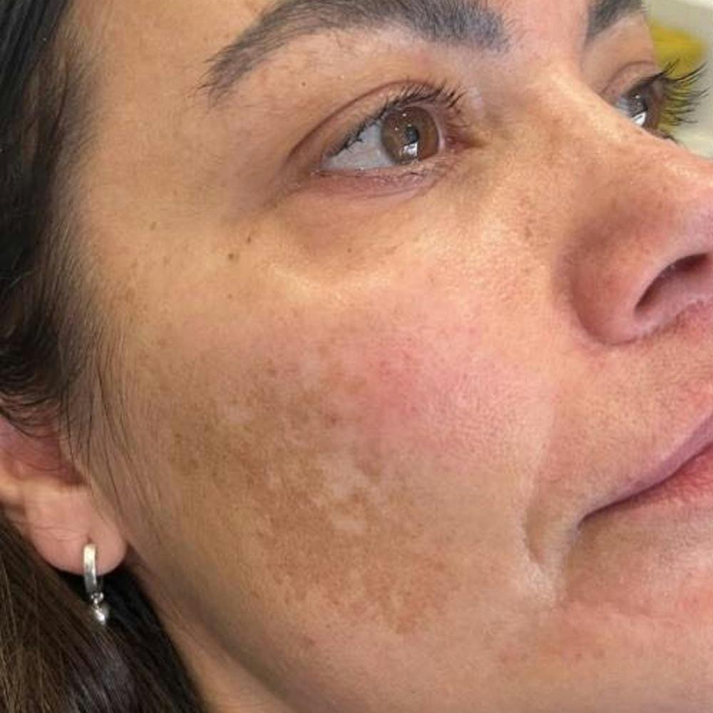 Focus facial treatment (before)