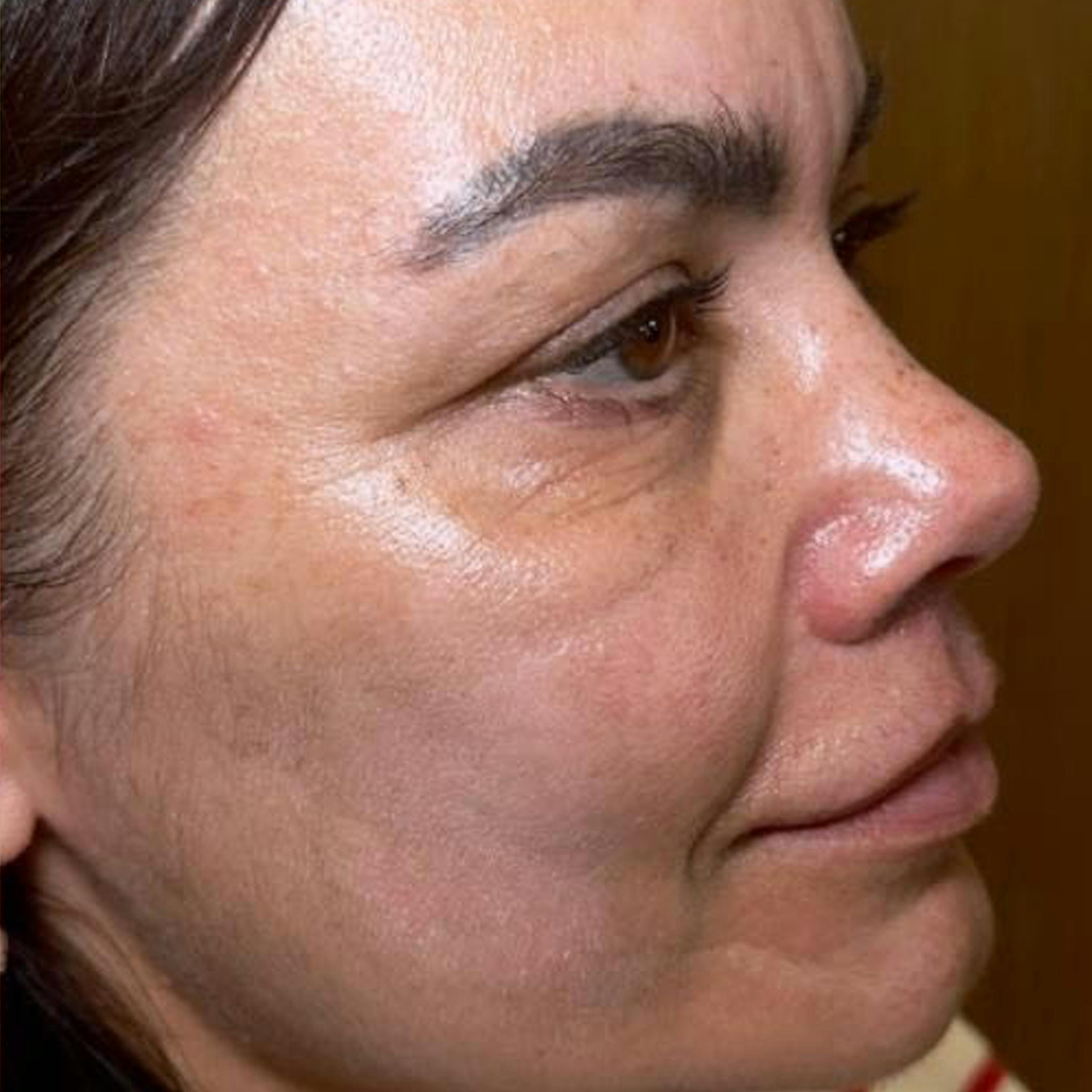 Focus facial treatment (after)
