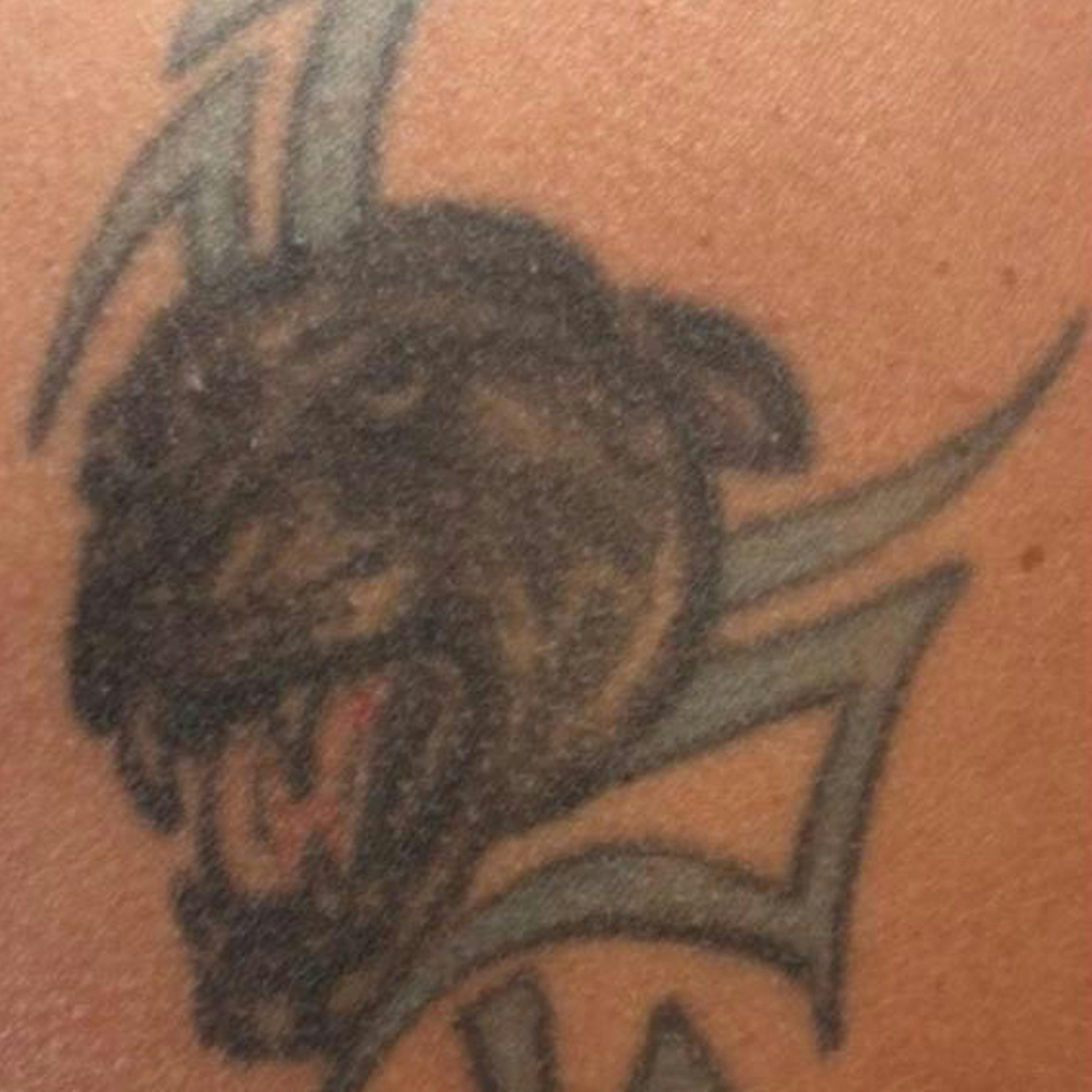 Laser Tattoo Removal (before)