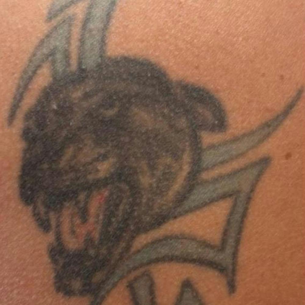 Laser Tattoo Removal (before)