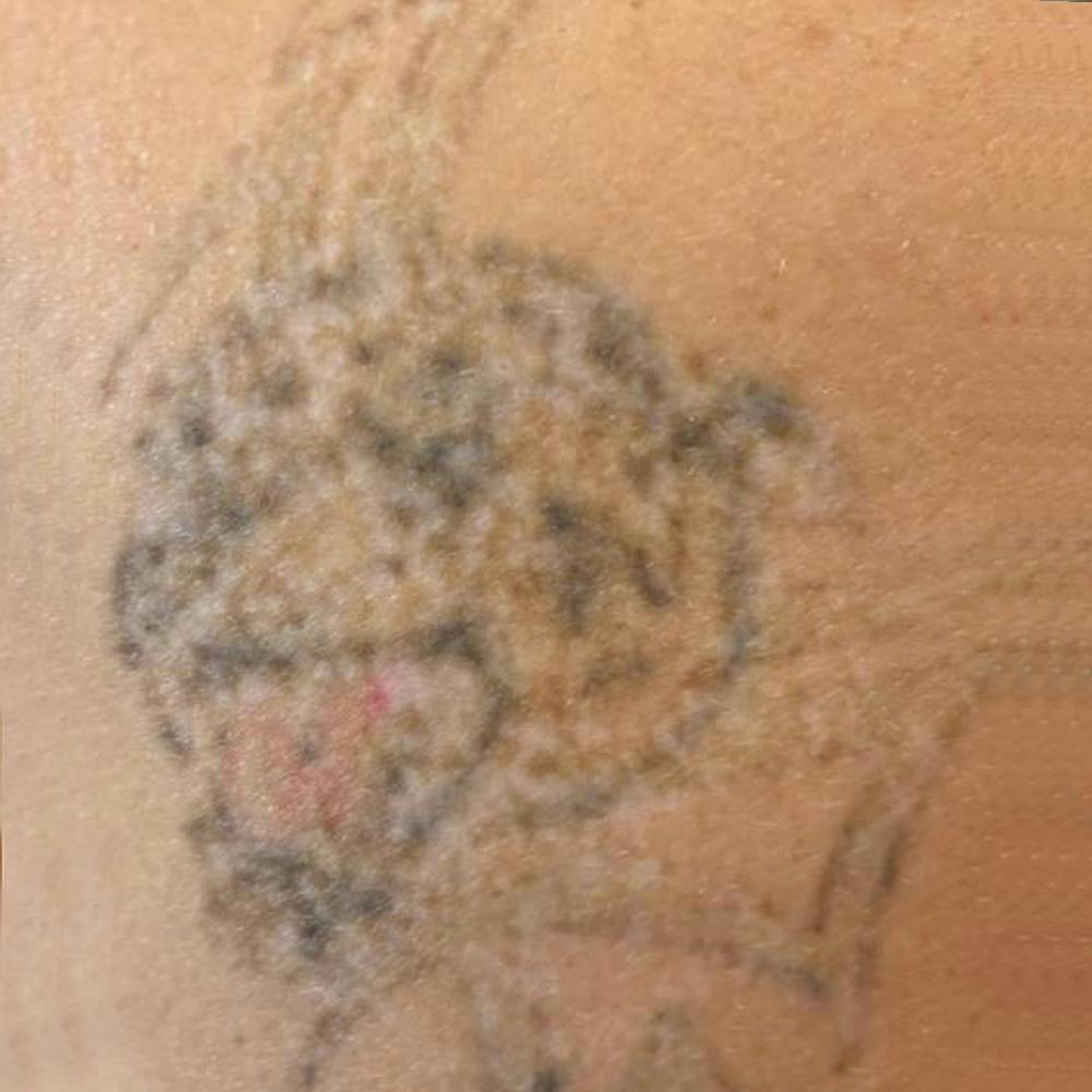 Laser Tattoo Removal (after)