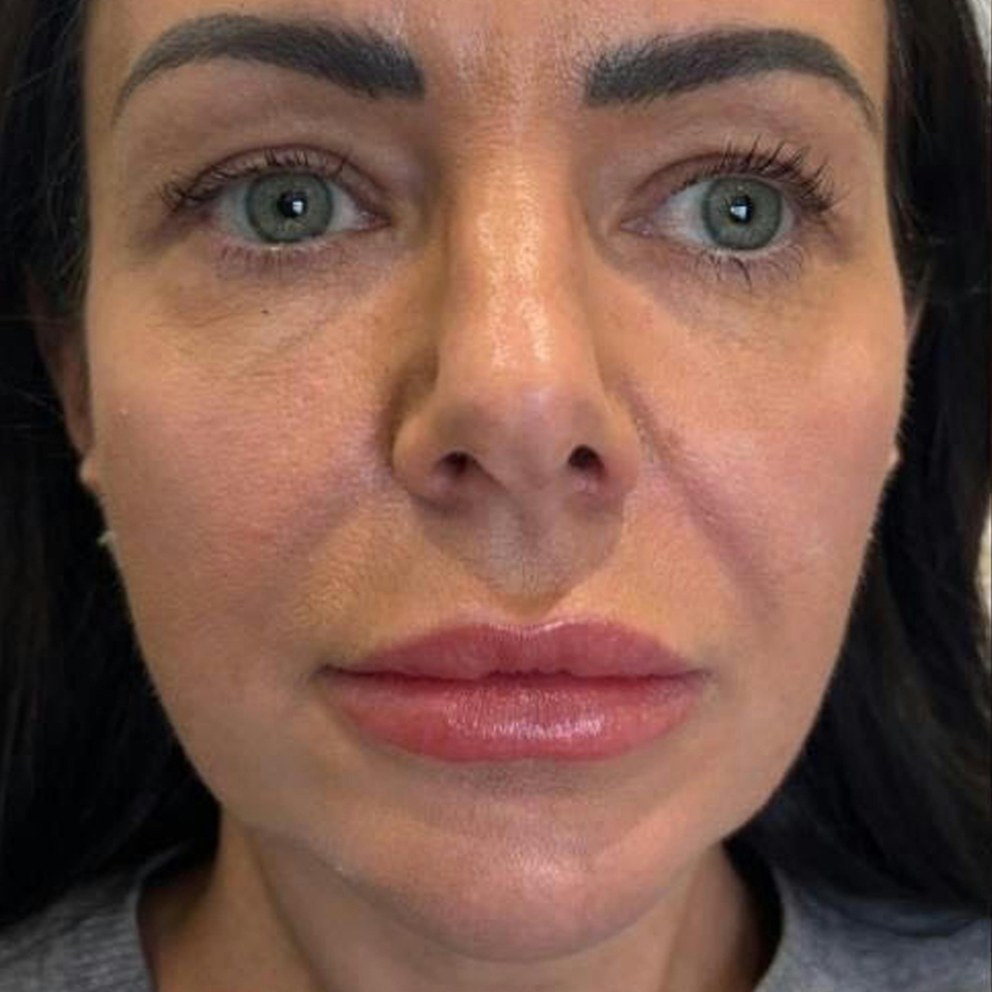 Dermal Fillers (before)