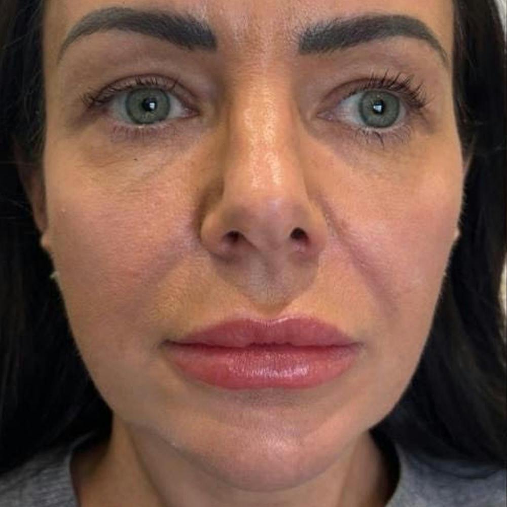 Dermal Fillers (before)