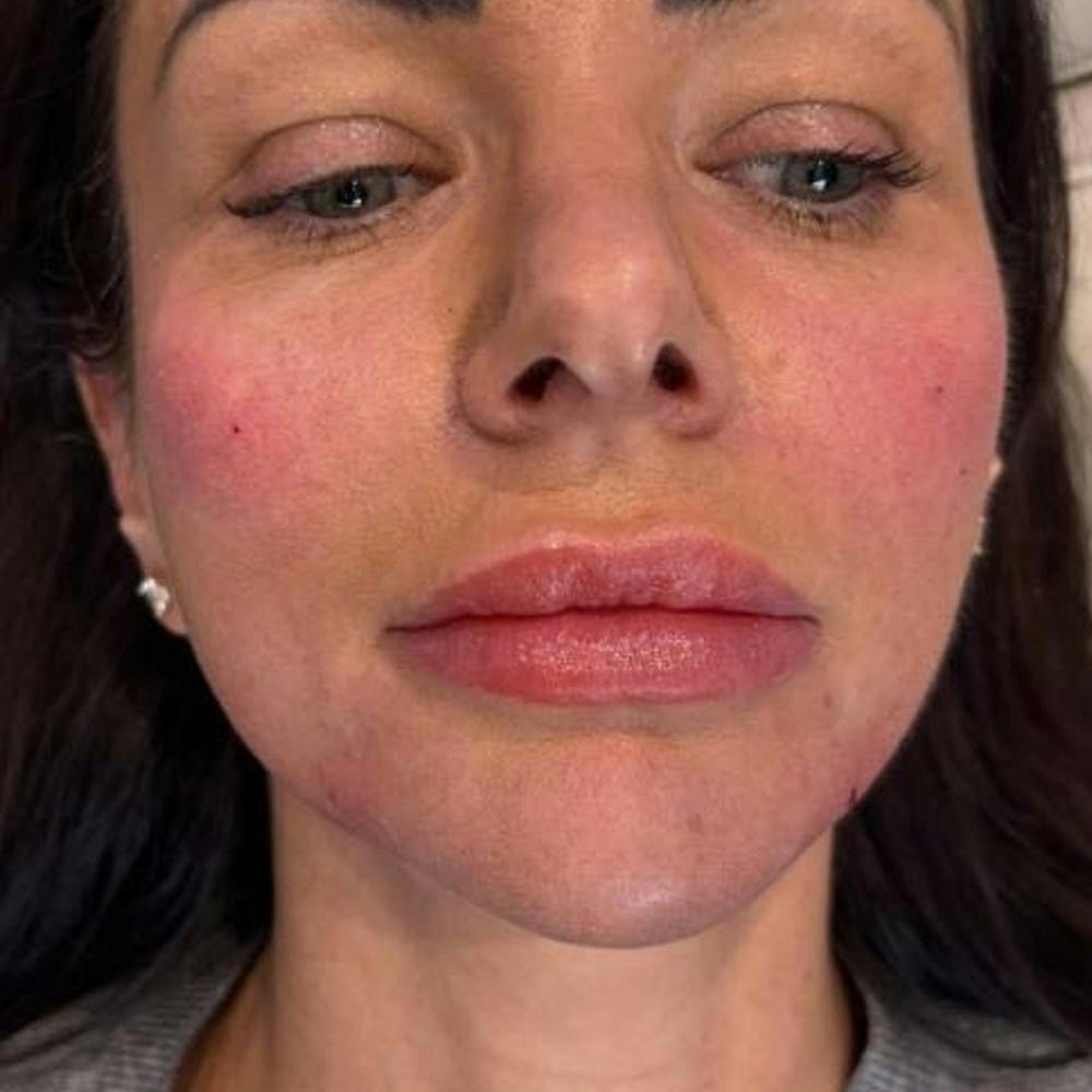 Dermal Fillers (after)
