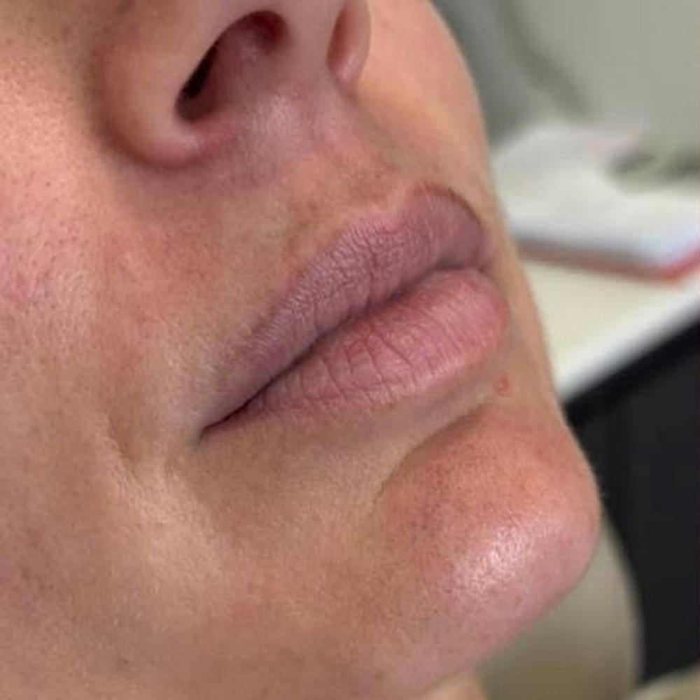 Dermal Fillers (before)