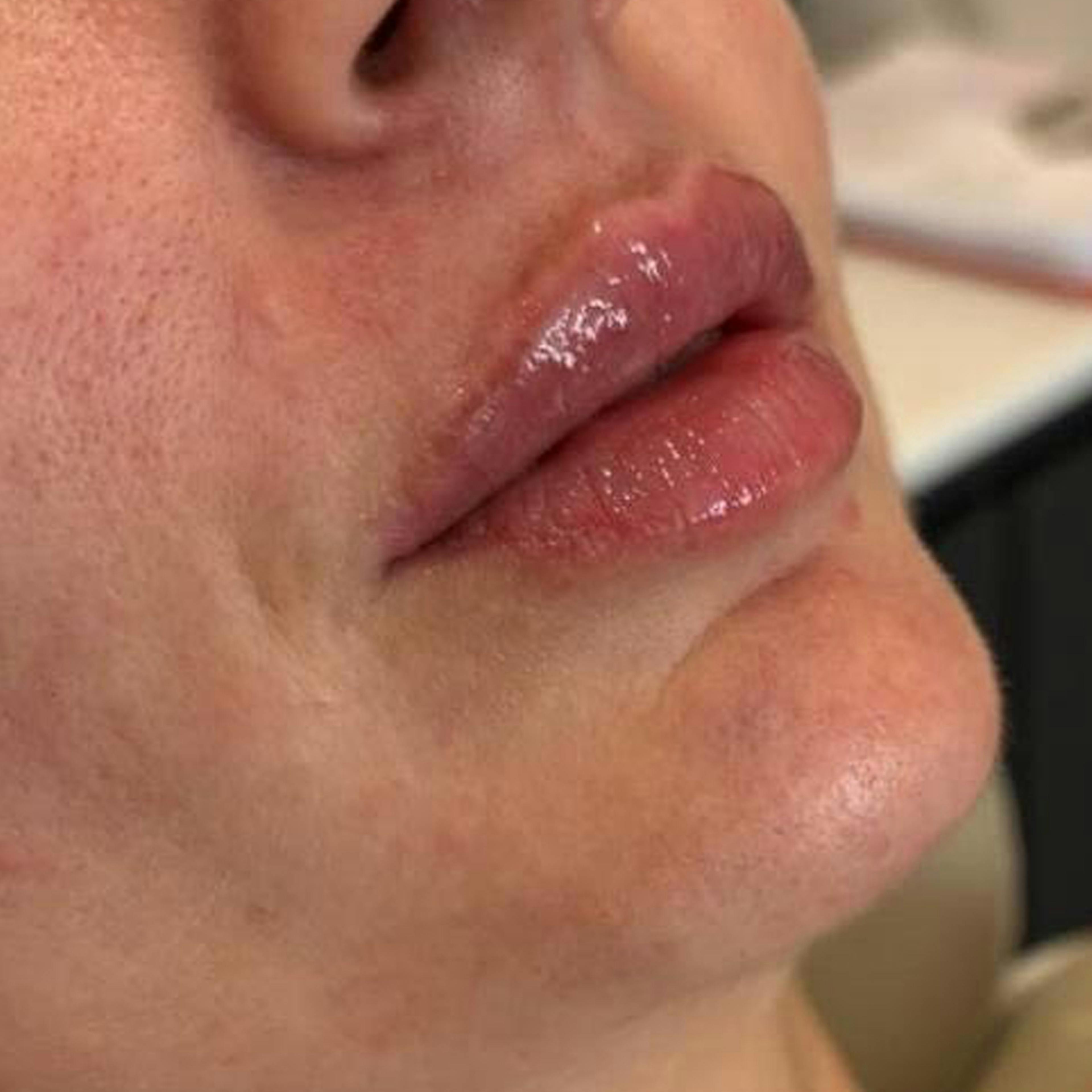 Dermal Fillers (after)