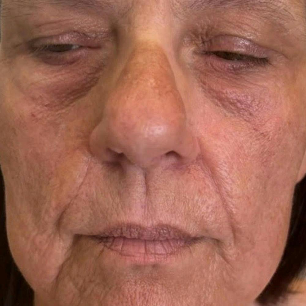 Dermal Fillers (before)