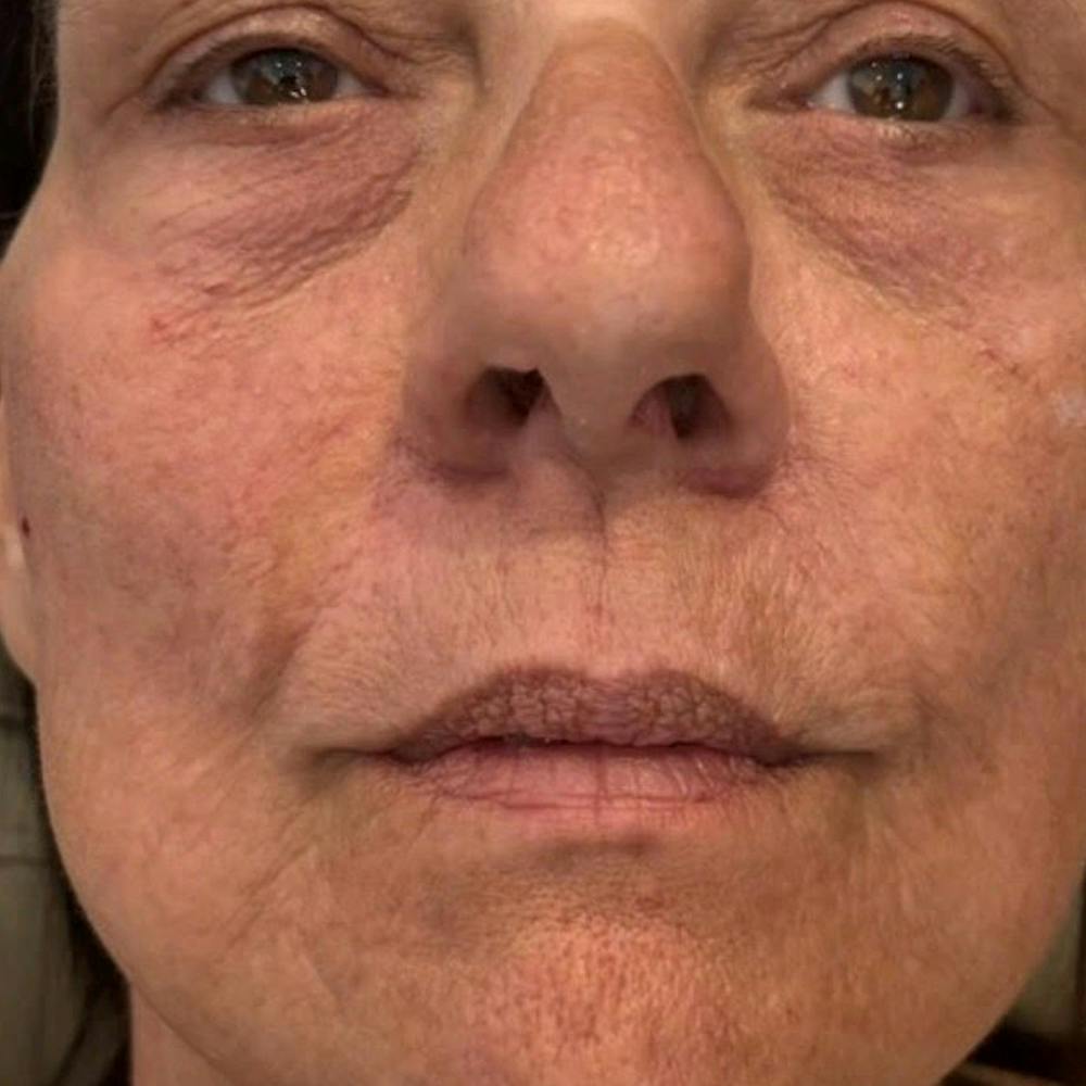 Dermal Fillers (after)