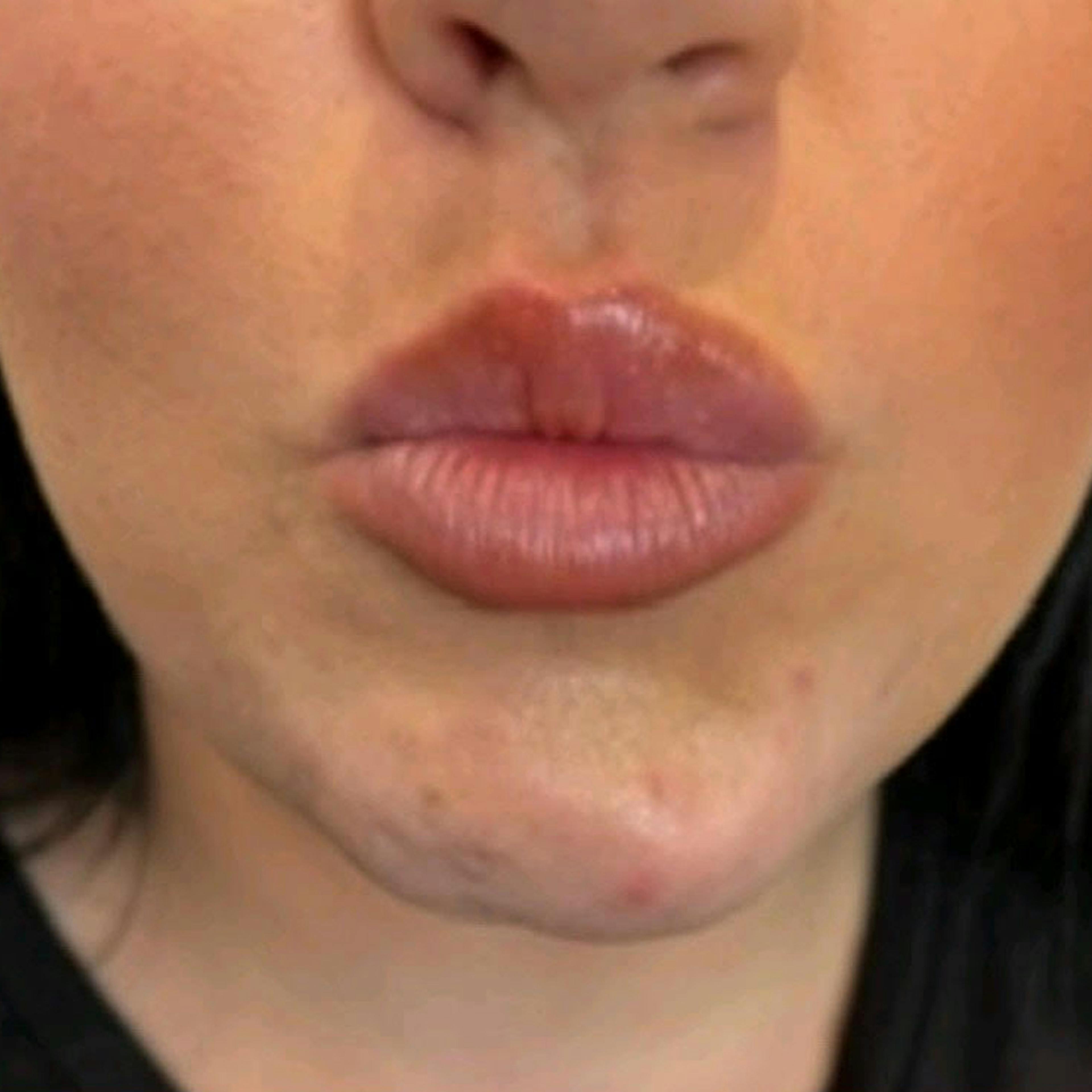 Dermal Fillers (before)