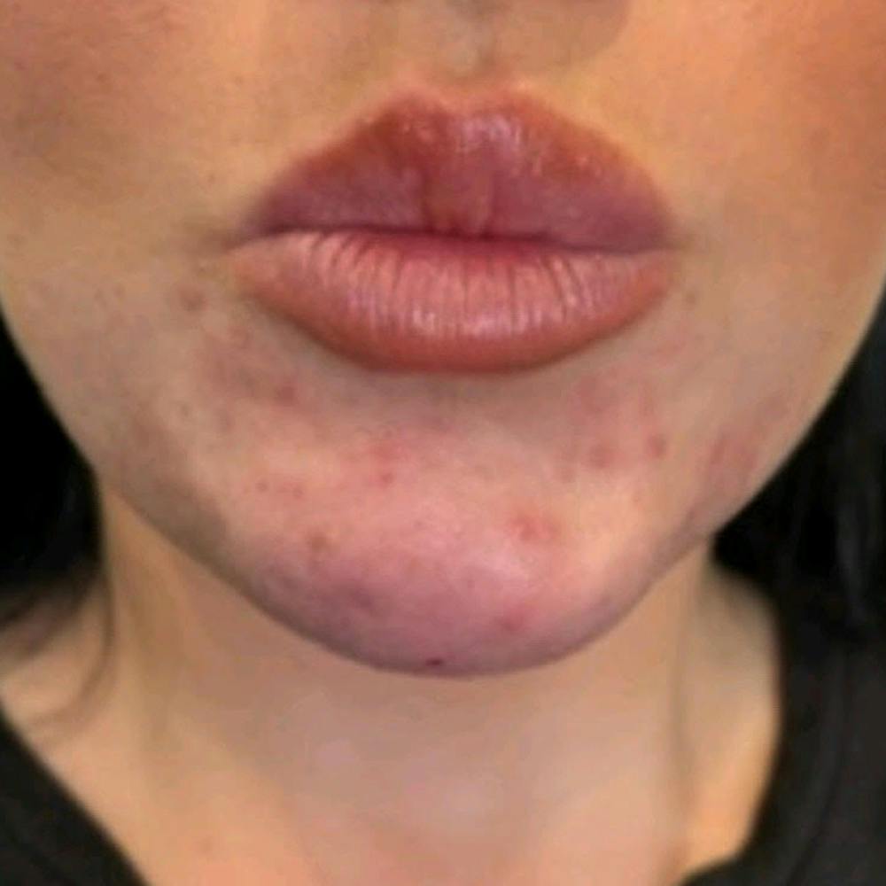 Dermal Fillers (after)