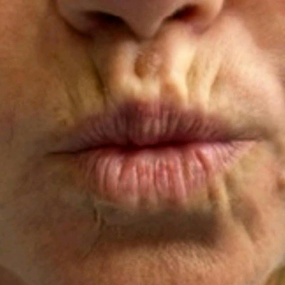 Dermal Fillers (before)