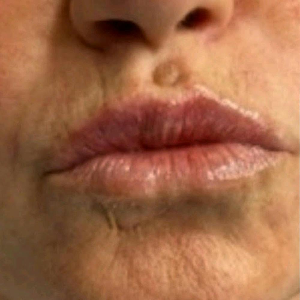 Dermal Fillers (after)