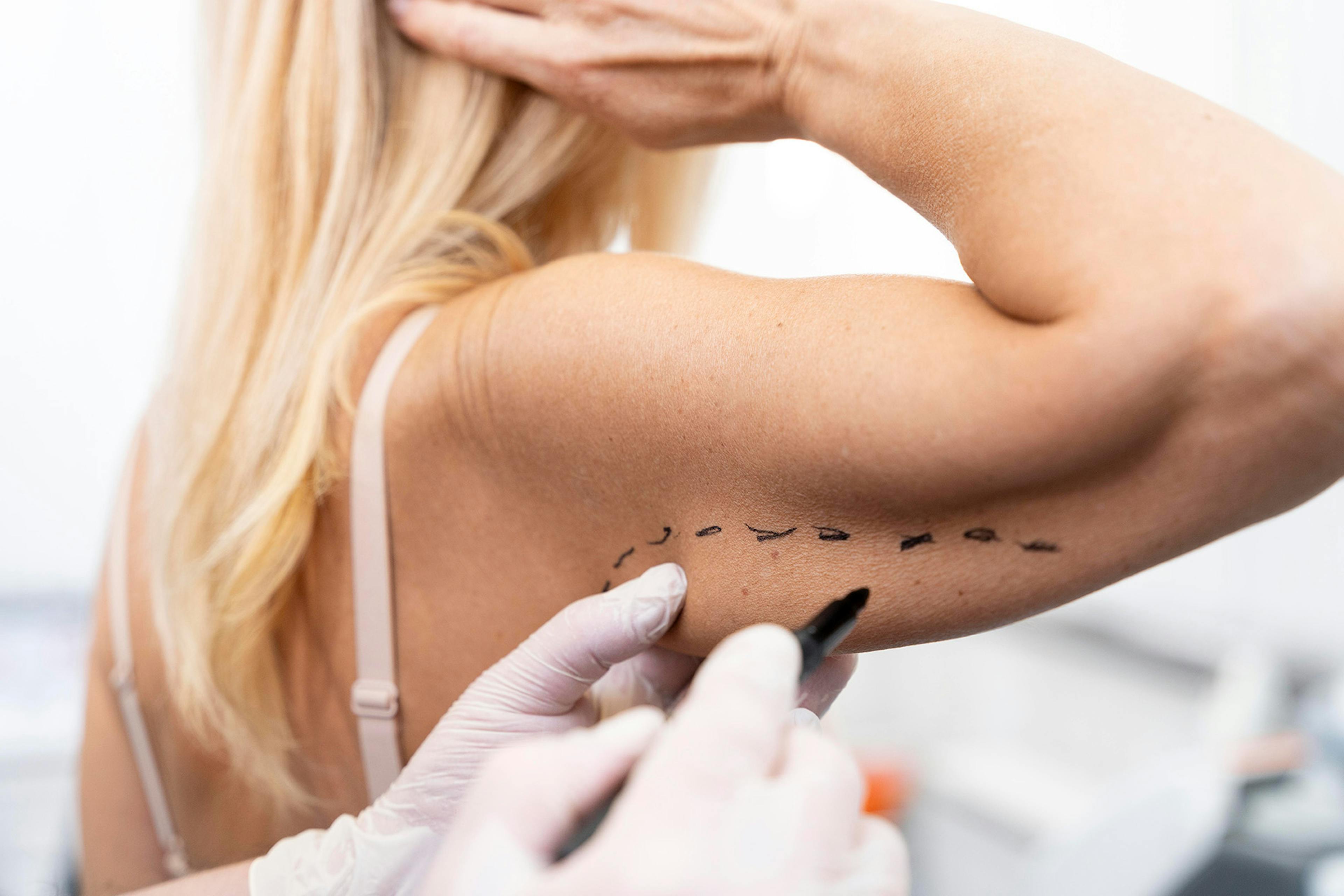 woman having arm slimming botox treatment