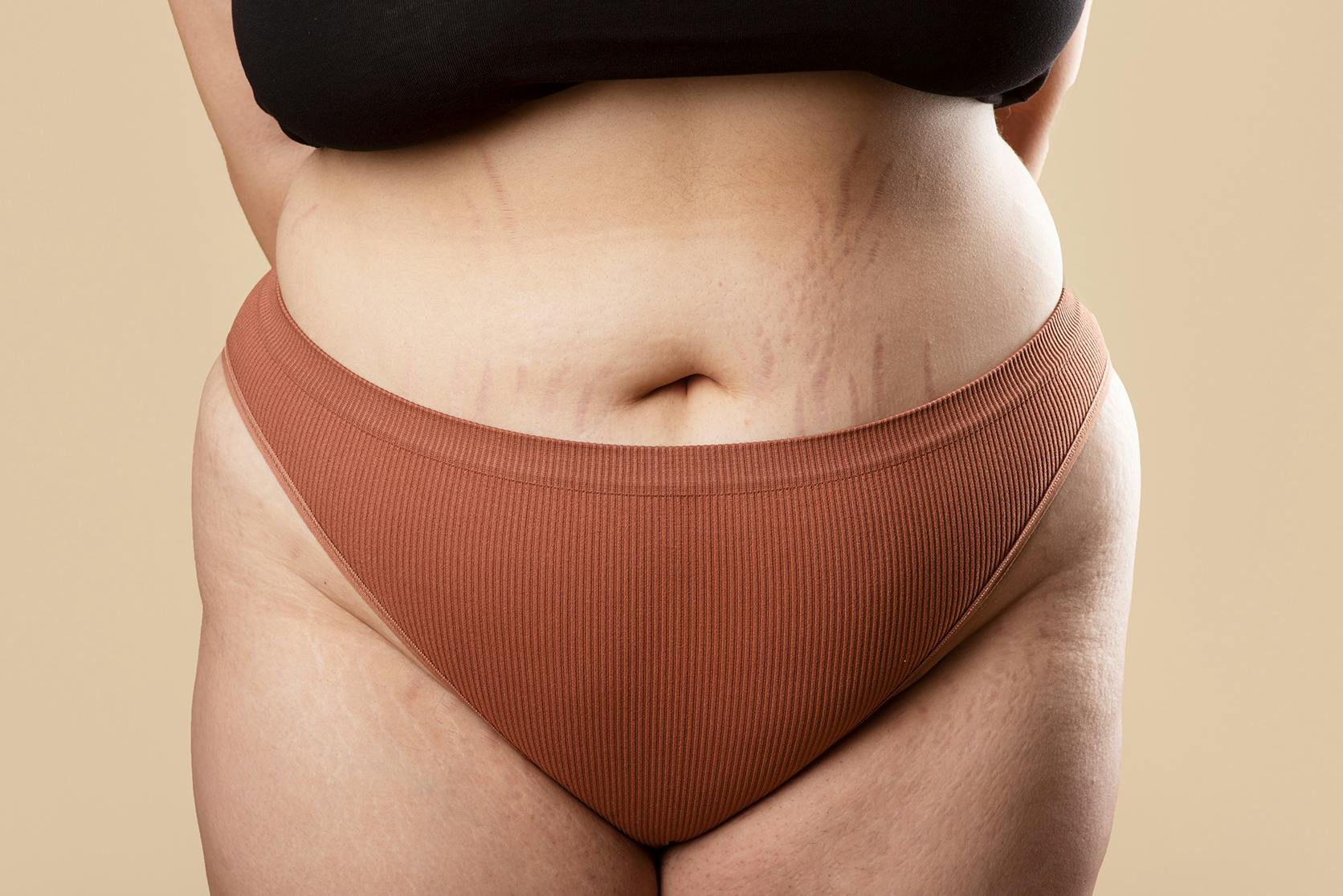 close up of a womans stretch marks