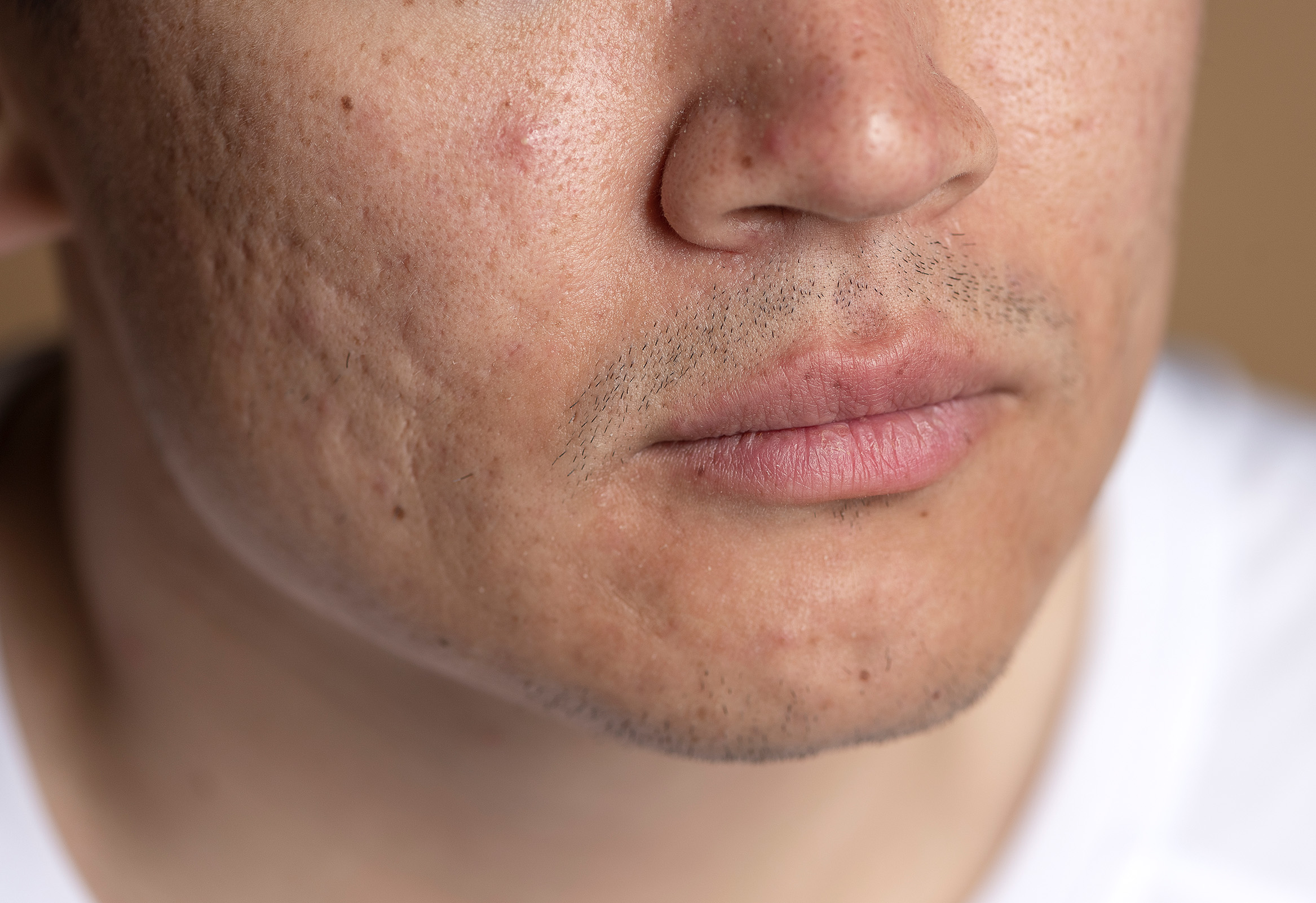man with acne scarring