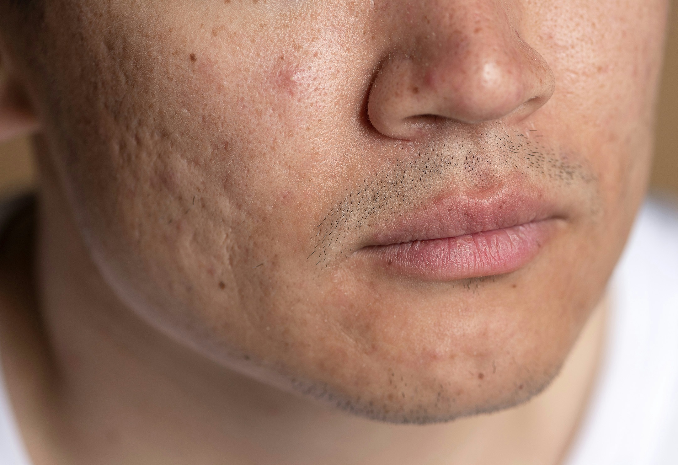 man with acne scarring