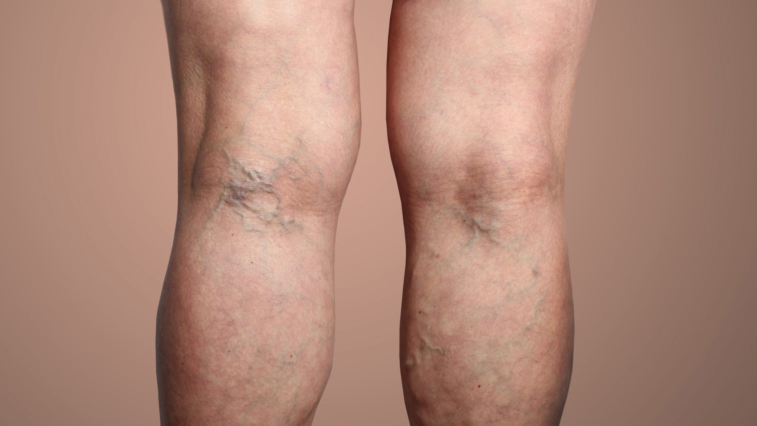 Legs with varicose veins