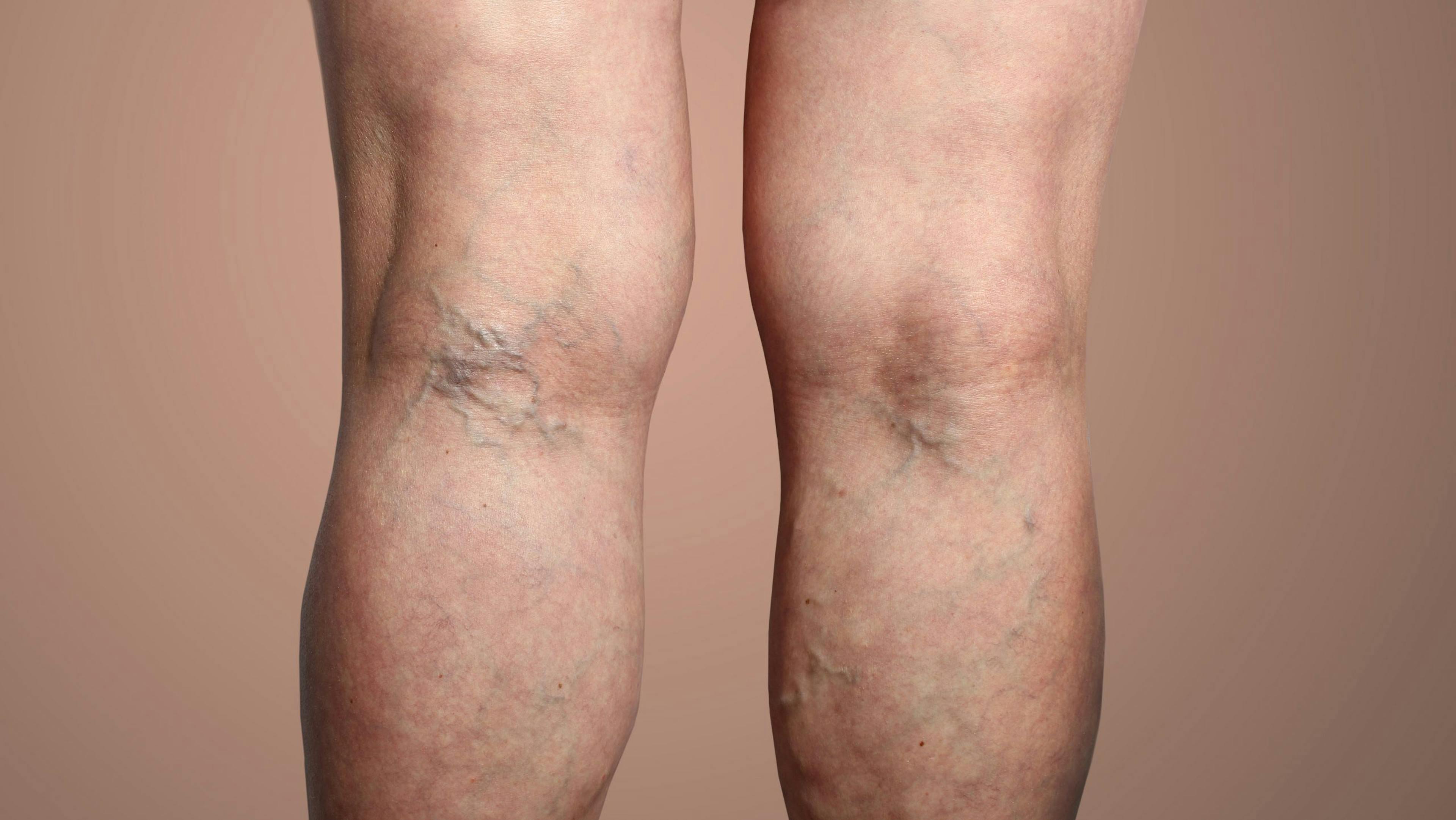 Legs with varicose veins