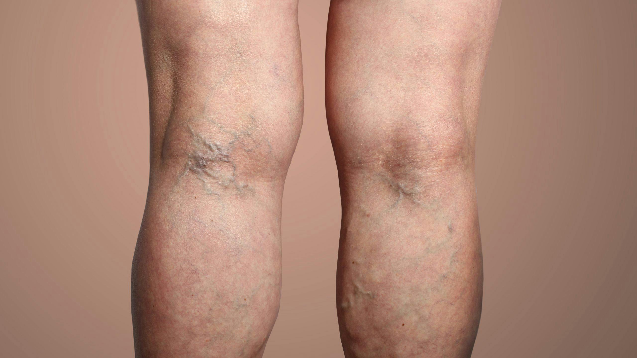 Legs with varicose veins