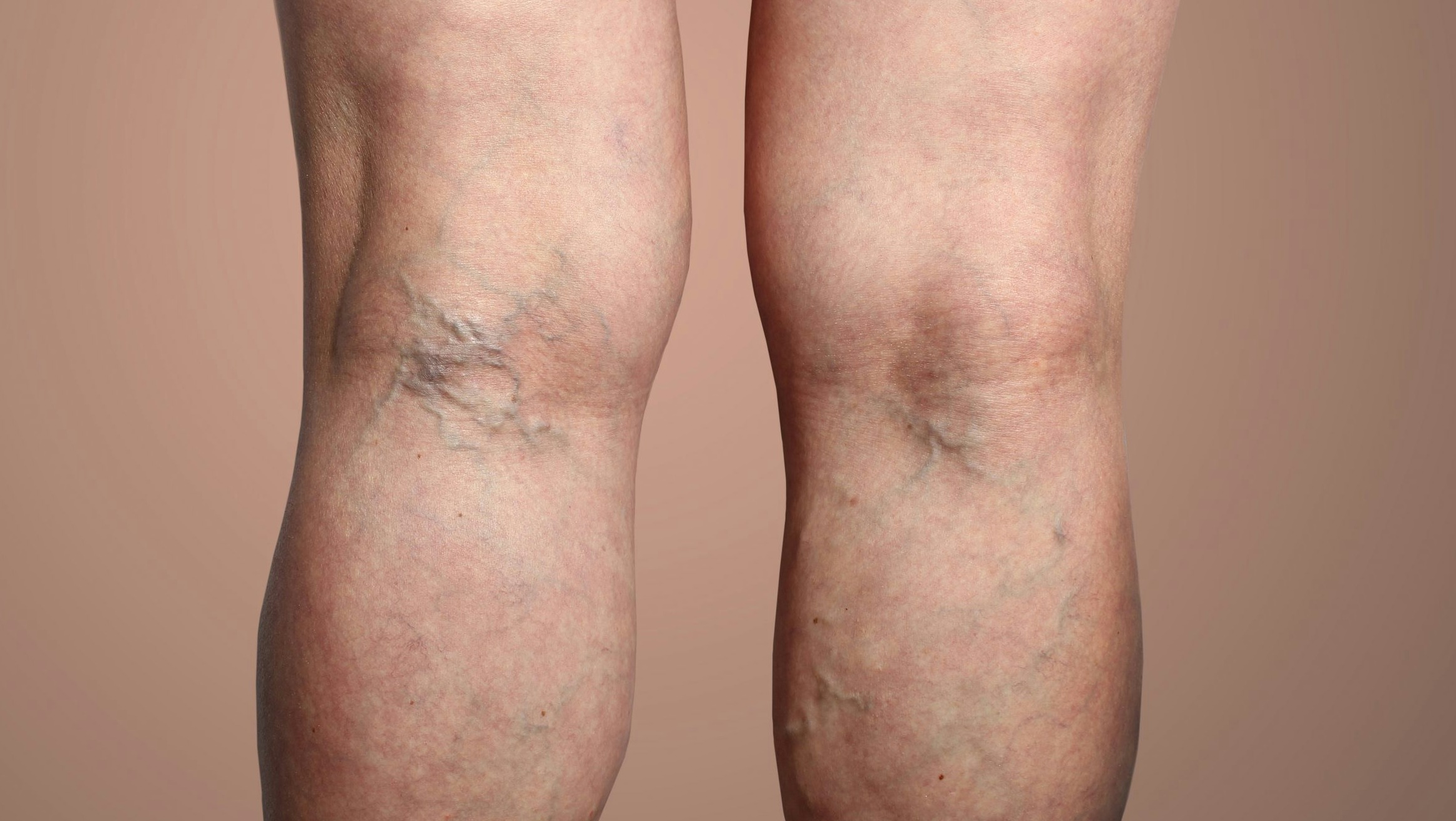 Legs with varicose veins