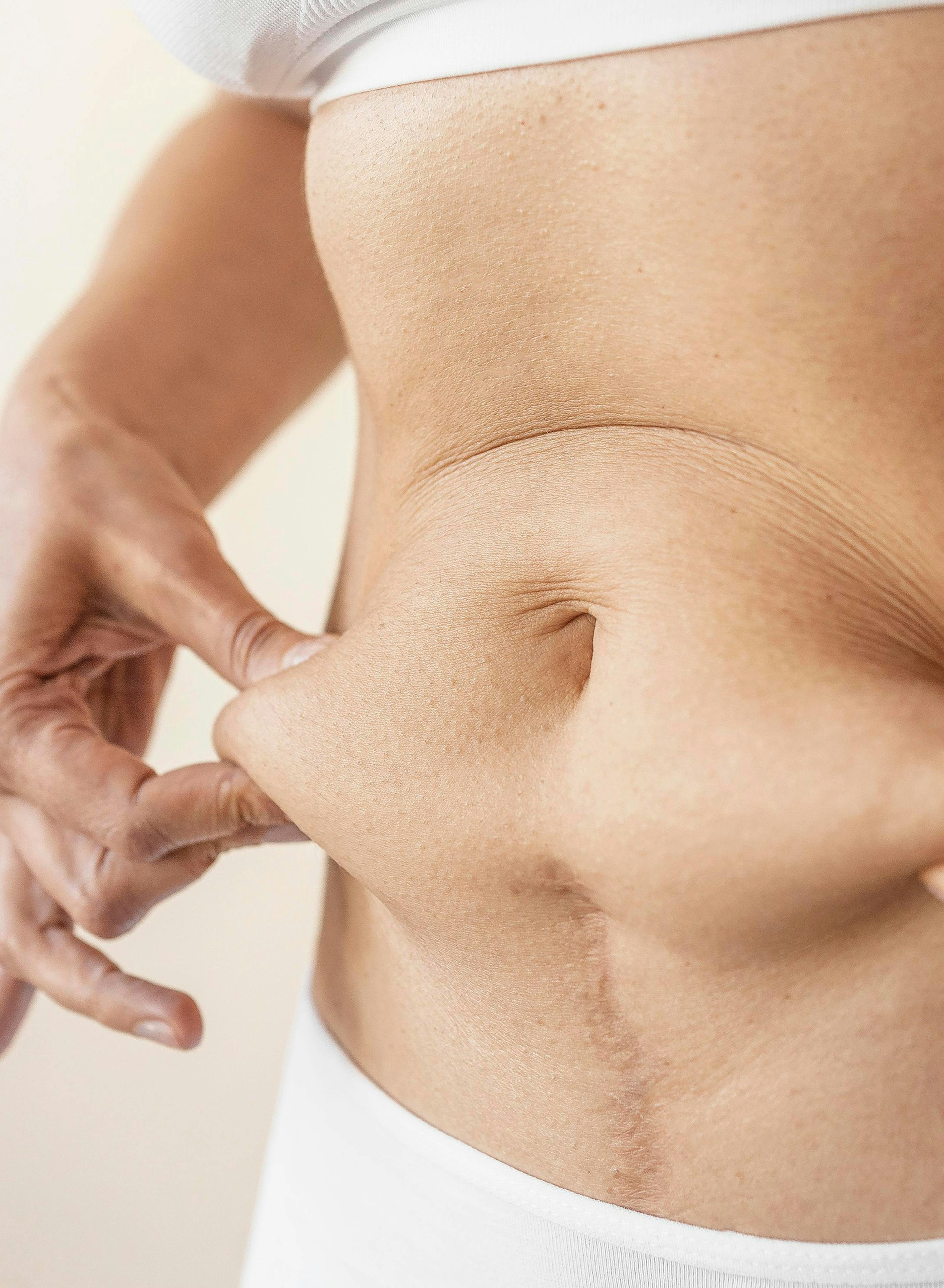 A woman holding the fat of her body around the belly area