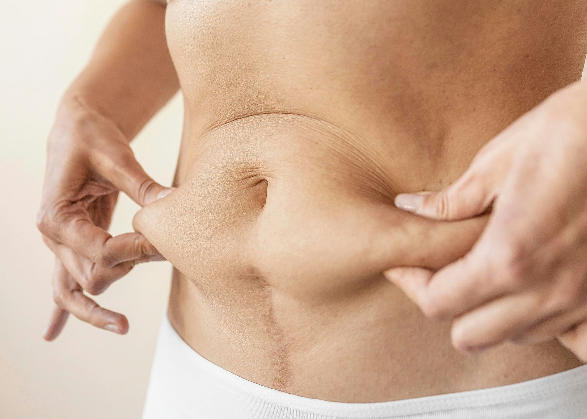 A female patient gripping the fat around her belly area