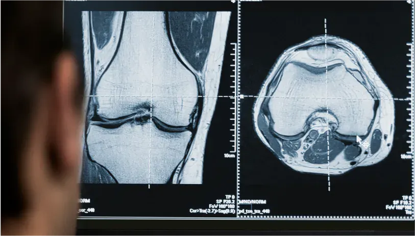 DENSITOMETRIA ÓSSEA