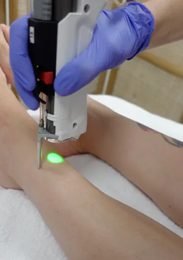 Avantages de l’épilation laser